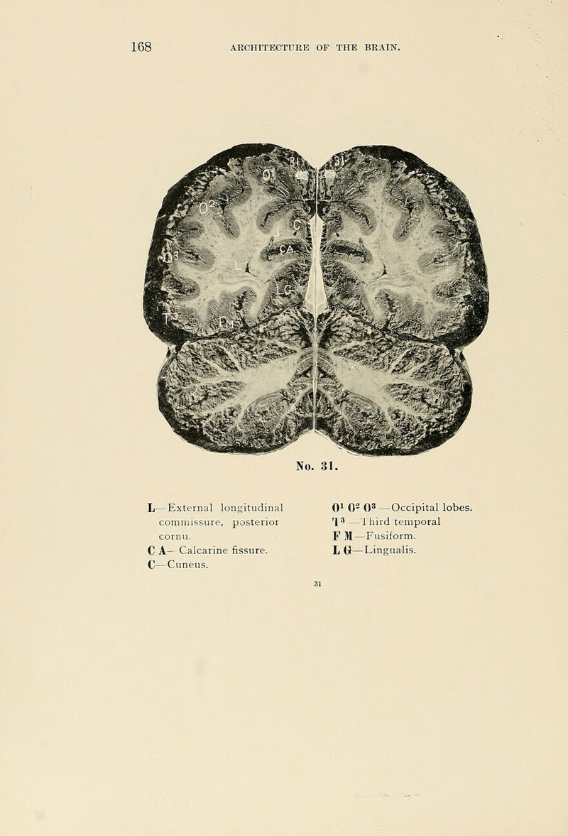 No. 31. L—External longitudinal commissure, posterior cornu. C—Cuneus. Qi 0- 0^ —Occipital lobes. '1*—Third temporal F M—Fusiform.