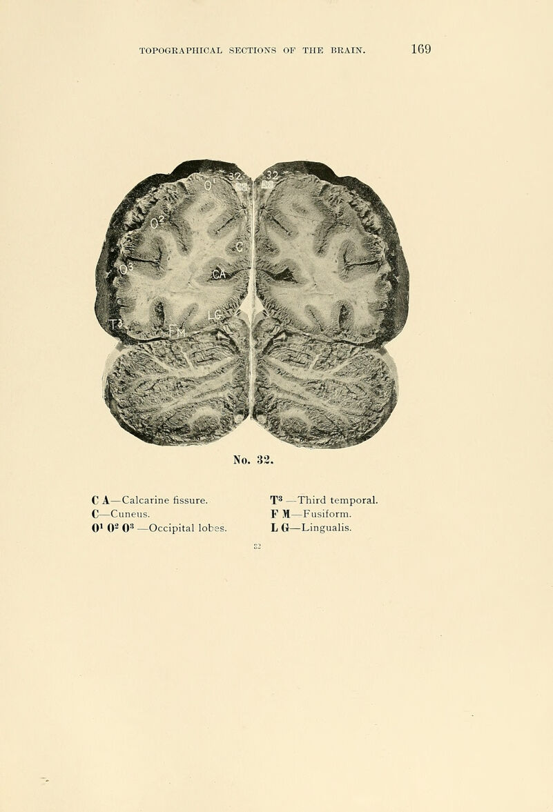 No. 32. C A—Calcarine fissure. C—Cuneus. T* —Third temporal. F M—Fusiform.