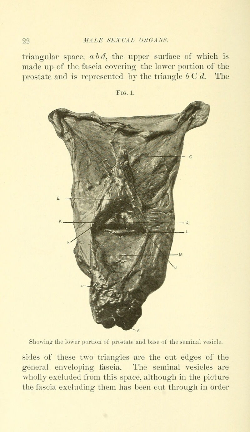 triangular space, abd, the upper surface of which is made up of the fascia covering the lower portion of the prostate and is represented by the triangle b C d. The Fig. 1. Showing the lower portion of prostate and base of the seminal vesicle. sides of these two triangles are the cut edges of the general enveloping fascia. The seminal vesicles are wholly excluded from this space, although in the picture the fascia excluding them has been cut through in order