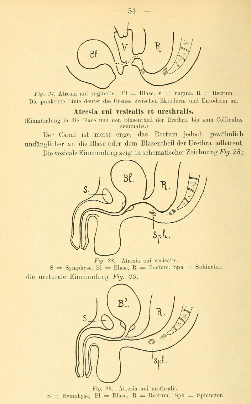 Fig. 27. Atresia ani vaginalis. Bl = Blase, V = Vagina. B = Bectum. Die punktirte Linie deutet die Grenze zwischen Ektoderm und Entoderm an. Atresia ani vesicalis et urethralis. (Einmündung in die Blase und den Blasentheil der Urethra, bis zum Colliculus seminalis.) Der Canal ist meist enge, das Rectum jedoch gewöhnlich umfänglicher an die Blase oder dem Blasentheil der Urethra adhärent. Die vesicale Einmündung zeigt in schematischer Zeichnung Fig. 28; Fig. 28. Atresia ani vesicalis. S = Symphyse, Bl = Blase, B = Bectum, Sph die urethrale Einmündung Fig. 29. Sphincter. Fig. 29. Atresia ani urethralis. S = Symphyse, Bl = Blase, B = Bectum, Sph = Sphincter.