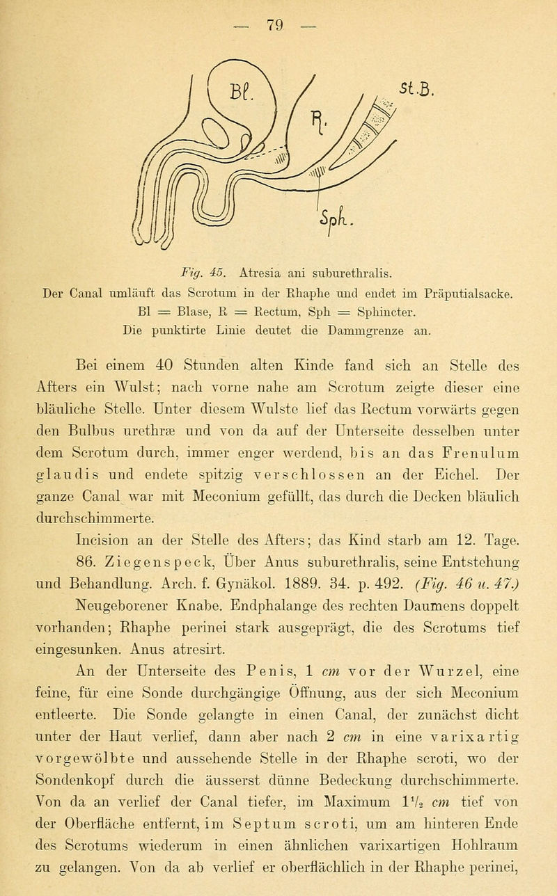 Fig. 45. Atresia ani suburethralis. Der Canal umläuft das Scrotum in der Rhaphe und endet im Präputialsacke. Bl = Blase, R = Rectum, Sph = Spliincter. Die punktirte Linie deutet die Dammgrenze an. Bei einem 40 Stunden alten Kinde fand sieh an Stelle des Afters ein Wulst; nach vorne nahe am Scrotum zeigte dieser eine bläuliche Stelle. Unter diesem Wulste lief das Rectum vorwärts gegen den Bulbus urethral und von da auf der Unterseite desselben unter dem Scrotum durch, immer enger werdend, bis an das Frenulum glaudis und endete spitzig verschlossen an der Eichel. Der ganze Canal war mit Meconium gefüllt, das durch die Decken bläulich durchschimmerte. Incision an der Stelle des Afters; das Kind starb am 12. Tage. 86. Ziegenspeck, Über Anus suburethralis, seine Entstehung und Behandlung. Arch. f. Gynäkol. 1889. 34. p. 492. (Fig. 46 u. 47.) Neugeborener Knabe. Endphalange des rechten Daumens doppelt vorhanden; Bhaphe perinei stark ausgeprägt, die des Scrotums tief eingesunken. Anus atresirt. An der Unterseite des Penis, 1 cm vor der Wurzel, eine feine, für eine Sonde durchgängige Öffnung, aus der sich Meconium entleerte. Die Sonde gelangte in einen Canal, der zunächst dicht unter der Haut verlief, dann aber nach 2 cm in eine varix artig vorgewölbte und aussehende Stelle in der Rhaphe scroti, wo der Sondenkopf durch die äusserst dünne Bedeckung durchschimmerte. Von da an verlief der Canal tiefer, im Maximum IVa cm tief von der Oberfläche entfernt, im Septum scroti, um am hinteren Ende des Scrotums wiederum in einen ähnlichen varixartigen Hohlraum zu gelangen. Von da ab verlief er oberflächlich in der Rhaphe perinei,