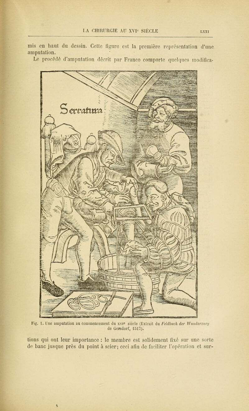 mis en haut du dessin. Cette figure est la première représentation d'une amputation. Le procédé d'amputation décrit par Franco comporte quelques raodifica- Fig. 1. Une amputation au commencement du xvie siècle (Extrait du Feldbuch der Wundarzney de Gersdorf, 1317). tions qui ont leur importance : le membre est solidement fixé sur une sorte de banc jusque près du point à scier; ceci afin de faciliter l'opération et sur-