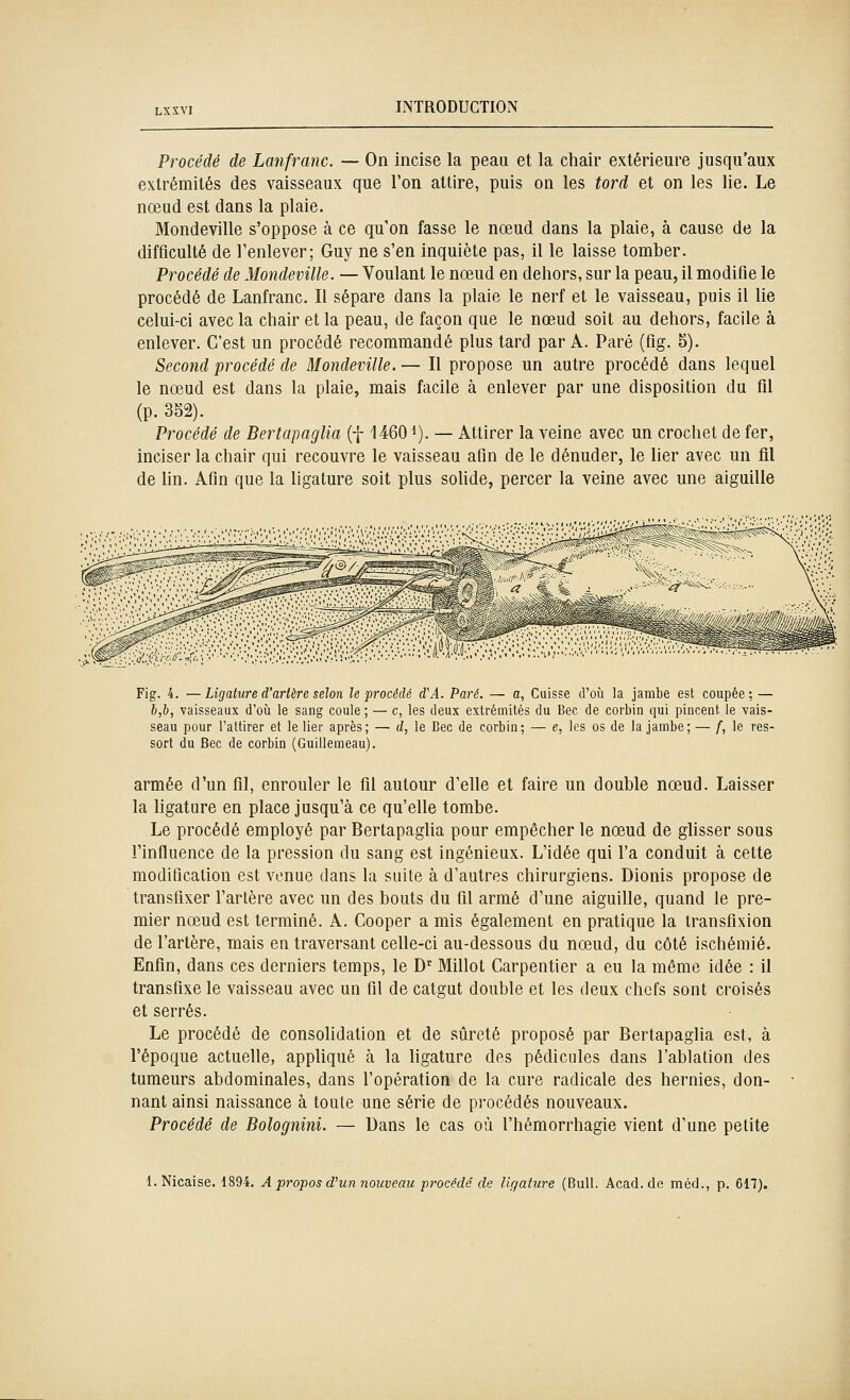 Procédé de Lanfranc. — On incise la peau et la chair extérieure jusqu'aux extrémités des vaisseaux que l'on attire, puis on les tord et on les lie. Le nœud est dans la plaie. Mondeville s'oppose à ce qu'on fasse le nœud dans la plaie, à cause de la difficulté de l'enlever; Guy ne s'en inquiète pas, il le laisse tomber. Procédé de Mondeville. — Voulant le nœud en dehors, sur la peau, il modifie le procédé de Lanfranc. Il sépare dans la plaie le nerf et le vaisseau, puis il lie celui-ci avec la chair et la peau, de façon que le nœud soit au dehors, facile à enlever. C'est un procédé recommandé plus tard par A. Paré (fig. 5). Second procédé de Mondeville.— Il propose un autre procédé dans lequel le nœud est dans la plaie, mais facile à enlever par une disposition du fil (p. 352). Procédé de Bertapaglia (f 14601). — Attirer la veine avec un crochet de fer, inciser la chair qui recouvre le vaisseau afin de le dénuder, le lier avec un fil de fin. Afin que la ligature soit plus solide, percer la veine avec une aiguille Fig. 4. —Ligature d'artère selon le procédé d'A. Paré. — o, Cuisse d'où la jambe est coupée; — b,b, vaisseaux d'où le sang coule ; — c, les deux extrémités du Bec de corbin qui pinceat le vais- seau pour l'attirer et le lier après; — d, le Bec de corbin; — e, les os de la jambe; — f, le res- sort du Bec de corbin (Guillemeau). armée d'un fil, enrouler le fil autour d'elle et faire un double nœud. Laisser la ligature en place jusqu'à ce qu'elle tombe. Le procédé employé par Bertapaglia pour empêcher le nœud de glisser sous l'influence de la pression du sang est ingénieux. L'idée qui l'a conduit à cette modification est venue dans la suite à d'autres chirurgiens. Dionis propose de transfixer l'artère avec un des bouts du fil armé d'une aiguille, quand le pre- mier nœud est terminé. A. Cooper a mis également en pratique la transfixion de l'artère, mais en traversant celle-ci au-dessous du nœud, du côté ischémie. Enfin, dans ces derniers temps, le D^ Millot Carpentier a eu la même idée : il transfixe le vaisseau avec un fil de catgut double et les deux chefs sont croisés et serrés. Le procédé de consolidation et de sûreté proposé par Bertapaglia est, à l'époque actuelle, appliqué à la ligature des pédicules dans l'ablation des tumeurs abdominales, dans l'opération de la cure radicale des hernies, don- nant ainsi naissance à toute une série de procédés nouveaux. Procédé de Bolognini. — Dans le cas où l'hémorrhagie vient d'une petite l.Nicaise. 1894. A propos d'un nouveau procédé de ligature (Bull. Acad.de méd., p. 617).