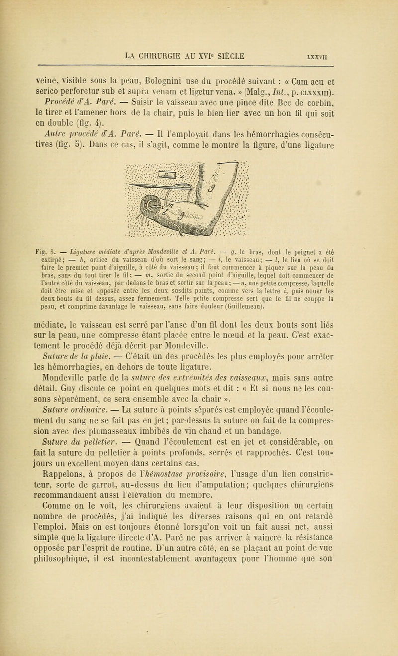 veine, visible sous la peau, Bolognini use du procédé suivant : « Cum acu et serico perforetur sub et supra venam et ligetur vena. « (Malg., Int., p. clxxxiii). Procédé d'A. Paré. — Saisir le vaisseau avec une pince dite Bec de corbin, le tirer et l'amener hors de la chair, puis le bien lier avec un bon fil qui soit en double (fig. 4). Autre procédé d'A. Paré. — Il l'employait dans les hémorrhagies consécu- tives (fig. o). Dans ce cas, il s'agit, comme le montre la figure, d'une ligature Fig. 0. — Ligature médiate d'après MondevUle et A. Paré. — g, le bras, dont le poignet a été extirpé; — h, orifice du vaisseau d'où sort le sang; — i, le vaisseau; — l, le lieu où se doit faire le premier point d'aiguille, à côté du vaisseau ; il faut commencer à piquer sur la peau du bras, sans du tout tirer le fil; — m, sortie du second point d'aiguille, lequel doit commencer de l'autre côté du vaisseau, par dedans le bras et sortir sur la peau ; — n, une petite compresse, laquelle doit être mise et apposée entre les deux susdits points, comme vers la lettre i, puis nouer les deuî bouts du fil dessus, assez fermement. Telle petite compresse sert que le fil ne cûuppe la peau, et comprime davantage le vaisseau, sans faire douleur (Guillemeaui. médiate, le vaisseau est serré par l'anse d'un fil dont les deux bouts sont liés sur la peau, une compresse étant placée entre le nœud et la peau. C'est exac- tement le procédé déjà décrit par Mondeville. Suture de la plaie. — C'était un des procédés les plus employés pour arrêter les hémorrhagies, en dehors de toute hgature. Mondeville parle de la suture des extrémités des vaisseaux, mais sans autre détail. Guy discute ce point en quelques mots et dit : « Et si nous ne les cou- sons séparément, ce sera ensemble avec la chair ». Suture ordinaire. — La suture à points séparés est employée quand l'écoule- ment du sang ne se fait pas en jet; par-dessus la suture on fait de la compres- sion avec des plumasseaux imbibés de vin chaud et un bandage. Suture du pelletier. — Quand l'écoulement est en jet et considérable, on fait la suture du pelletier à points profonds, serrés et rapprochés. C'est tou- jours un excellent moyen dans certains cas. Rappelons, à propos de Vhémostase provisoire, l'usage d'un lien constric- teur, sorte de garrot, au-dessus du heu d'amputation; quelques chirurgiens recommandaient aussi l'élévation du membre. Comme on le voit, les chirurgiens avaient à leur disposition un certain nombre de procédés, j'ai indiqué les diverses raisons qui en ont retardé l'emploi. Mais on est toujours étonné lorsqu'on voit un fait aussi net, aussi simple que la ligature directe d'A. Paré ne pas arriver à vaincre la résistance opposée par l'esprit de routine. D'un autre côté, en se plaçant au point de vue philosophique, il est incontestablement avantageux pour l'homme que son