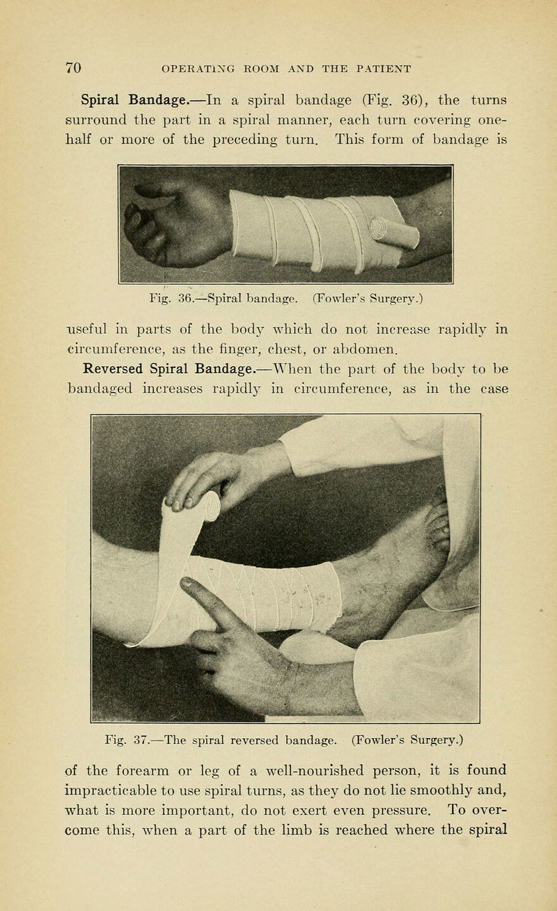 Spiral Bandage.—In a spiral bandage (Fig. 36), the turns surround the part in a spiral manner, each turn covering one- half or more of the preceding turn. This form of bandage is rig. 36.—Spiral bandage. (Fowler's Surgery.) useful in parts of the body which do not increase rapidly in circumference, as the finger, chest, or abdomen. Reversed Spiral Bandage.—When the part of the body to be bandaged increases rapidly in circumference, as in the case Fig. 37.—The spiral reversed bandage. (Fowler's Surgery.) of the forearm or leg of a well-nourished person, it is found impracticable to use spiral turns, as they do not lie smoothly and, what is more important, do not exert even pressure. To over- come this, when a part of the limb is reached where the spiral