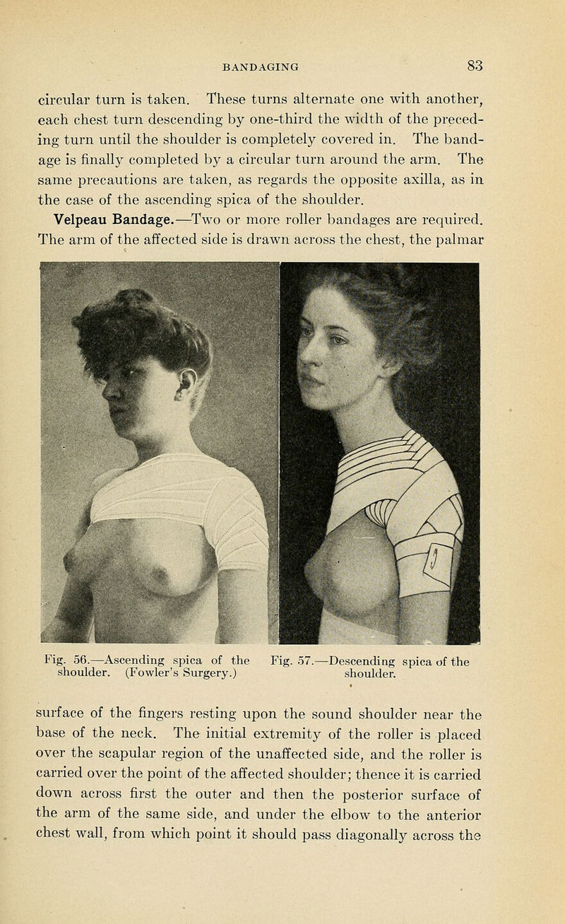 circular turn is taken. These turns alternate one with another, each chest turn descending by one-third the width of the preced- ing turn until the shoulder is completely covered in. The band- age is finally completed by a circular turn around the arm. The same precautions are taken, as regards the opposite axilla, as in the case of the ascending spica of the shoulder. Velpeau Bandage.—^Two or more roller bandages are required. The arm of the affected side is drawn across the chest, the palmar Fig. 56.—Ascending spica of the Fig. 57.—Descending spica of the shoulder. (Fowler's Surgery.) shoulder. surface of the fingers resting upon the sound shoulder near the base of the neck. The initial extremity of the roller is placed over the scapular region of the unaffected side, and the roller is carried over the point of the affected shoulder; thence it is carried down across first the outer and then the posterior surface of the arm of the same side, and under the elbow to the anterior chest wall, from which point it should pass diagonally across the