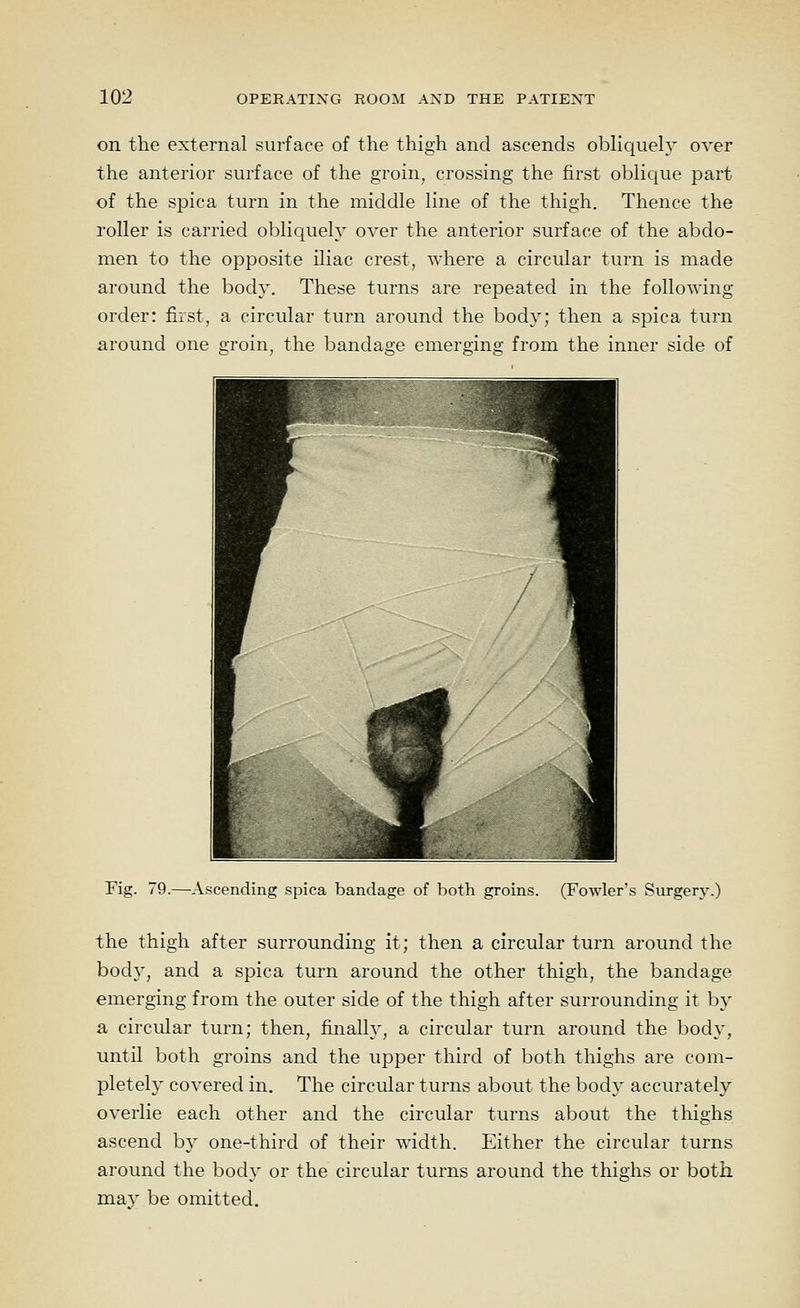 on the external surface of the thigh and ascends obliciuely over the anterior surface of the groin, crossing the first oblic^ue part of the spica turn in the middle line of the thigh. Thence the roller is carried oblicpely over the anterior surface of the abdo- men to the opposite iliac crest, where a circular turn is made around the body. These turns are repeated in the following- order: first, a circular turn around the body; then a spica turn around one groin, the bandage emerging from the inner side of Fig. 79.—Ascending spica bandage of both groins. (Fowler's Surgery.) the thigh after surrounding it; then a circular turn around the body, and a spica turn around the other thigh, the bandage emerging from the outer side of the thigh after surrounding it by a circular turn; then, finally, a circular turn around the bod}', until both groins and the upper third of both thighs are com- pletely covered in. The circular turns about the boch' accurately overlie each other and the circular turns about the thighs ascend by one-third of their width. Either the circular turns around the body or the circular turns around the thighs or both may be omitted.