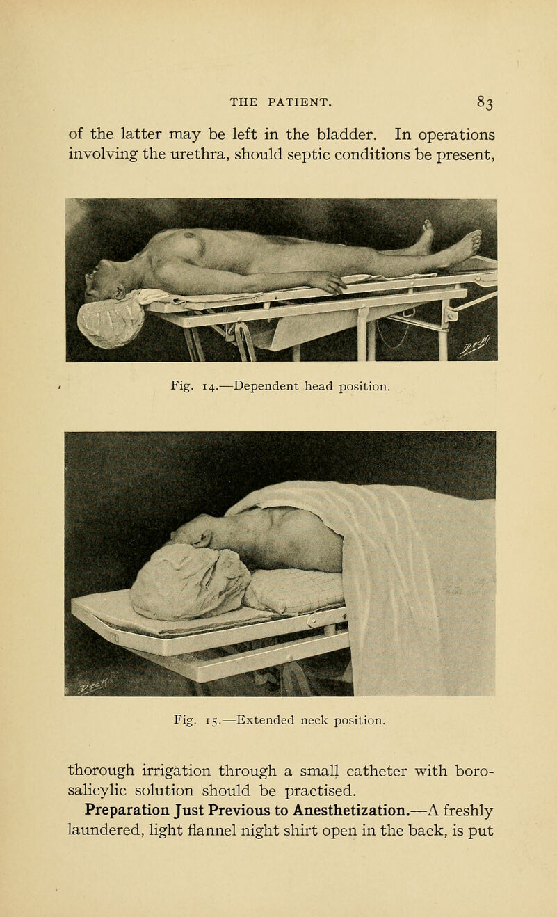 of the latter may be left in the bladder. In operations involving the urethra, should septic conditions be present, Fig. 14.—Dependent head position. Fig. 15.—Extended neck position. thorough irrigation through a small catheter with boro- salicylic solution should be practised. Preparation Just Previous to Anesthetization.—A freshly laundered, light flannel night shirt open in the back, is put