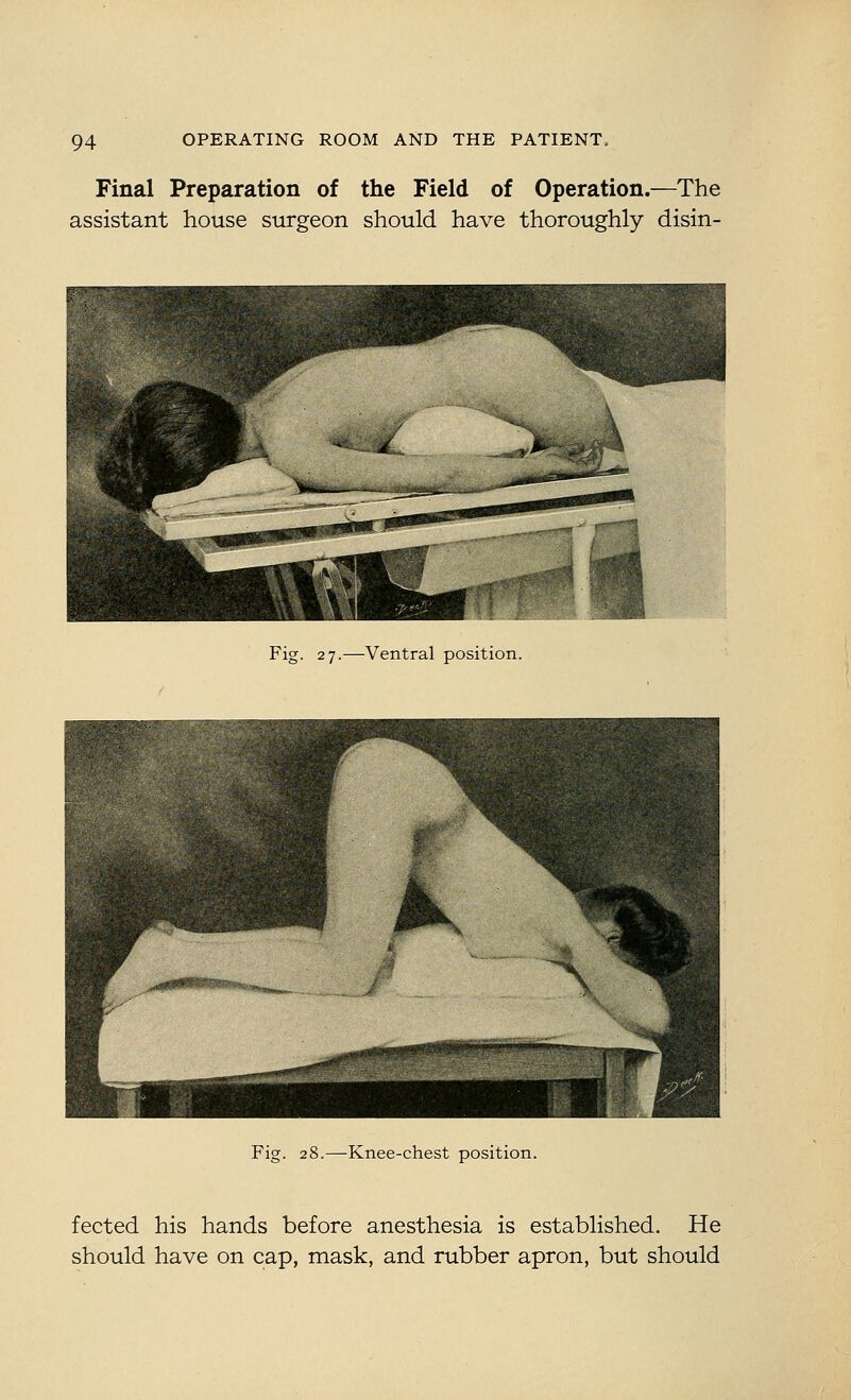 Final Preparation of the Field of Operation.—The assistant house surgeon should have thoroughly disin- Fig. 27.—Ventral position. Fig. 28.—Knee-chest position. fected his hands before anesthesia is established. He should have on cap, mask, and rubber apron, but should