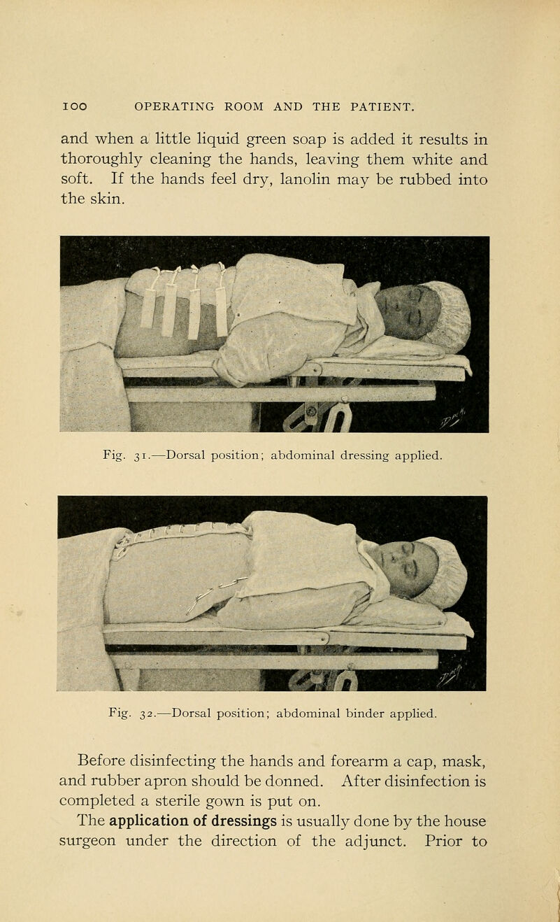 and when a little liquid green soap is added it results in thoroughly cleaning the hands, leaving them white and soft. If the hands feel dry, lanolin may be rubbed into the skin. Fig. 31.—Dorsal position; abdominal dressing applied. Fig. 32.—Dorsal position; abdominal binder applied. Before disinfecting the hands and forearm a cap, mask, and rubber apron should be donned. After disinfection is completed a sterile gown is put on. The application of dressings is usually done by the house surgeon under the direction of the adjunct. Prior to