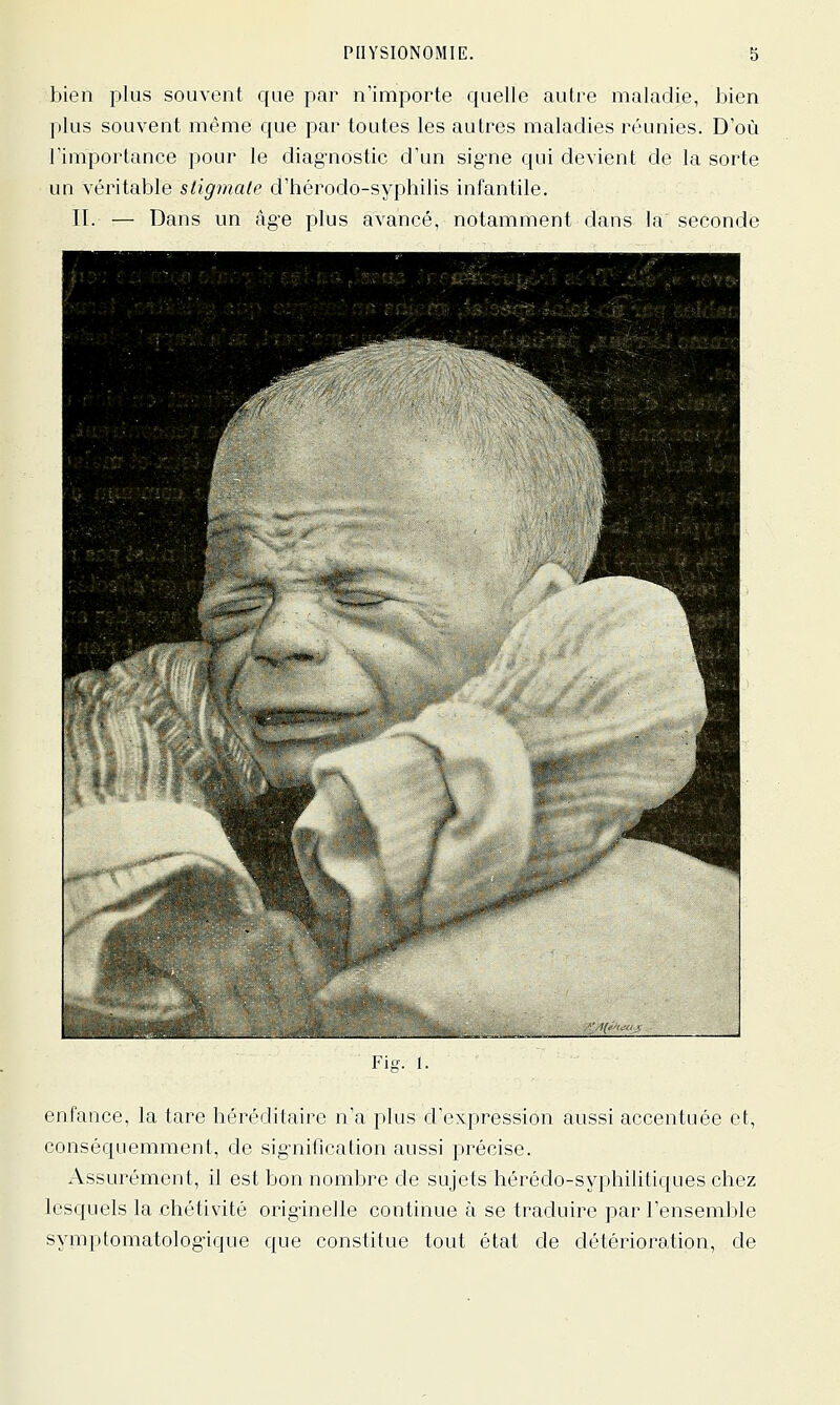 bien plus souvent que par n'importe quelle autre maladie, bien plus souvent même que par toutes les autres maladies réunies. D'où l'importance pour le diag-nostic d'un sig-ne qui devient de la sorte un véritable stigmate d'hérodo-syphilis infantile. II. — Dans un àg-e plus avancé, notamment dans la seconde Fiiï. 1. enfance, la tare héréditaire n'a plus d'expression aussi accentuée et, conséquemment, de sig-nification aussi précise. i\ssurément, il est bon nombre de sujets hérédo-syphilitiques chez lesquels la chétivité originelle continue à se traduire par l'ensemble symptomatolog-ique que constitue tout état de détérioration, de