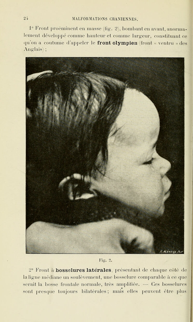 i° Front proéminent en masse (fig\ 2), bombant en avant, anorma- lement développé comme hauteur et comme larg^eur, constituant ce qu'on a coutume d'appeler le front olympien l'front « ventru >> des iVus-lais) ; Fig, 2. 2° Front à bosselures latérales, présentant de chaque côté de la ligne méchane un soulèvement, une bosselure comparable à ce que serait la bosse frontale normale, très amplifiée. -— Ces bosselures sont presque toujours bilatérales ; mais elles peuvent être plus