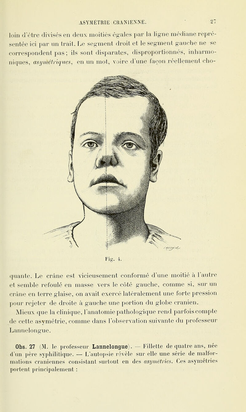 loin d'être divisés en deux moitiés ég-ales par la lig-ne médiane repré- sentée ici par un trait. Le seg-ment droit et le seg-ment g-auche ne se correspondent pas ; ils sont disparates, disproportionnés, inharmo- niques, asymétriques, en un mot, voire d'une façon réellement cho- jr.^lé. Fiff. 4. quante. Le crâne est vicieusement conformé d'une moitié à l'autre et semhjle refoulé en masse vers le côté g^auche, comme si, sur un crâne en terre glaise, on avait exercé latéralement une forte pression pour rejeter de droite à gauche une portion du giobe crânien. Mieux que la chnique, l'anatomie pathologique rend parfois compte de cette asymétrie, comme dans l'observation suivante du professeur Lannelong'ue. Obs. 27 (M. le professeur Lannelongue). — Fillette de quatre ans, née (l'un père syphilitique. — L'autopsie révèle sur elle une série de malfor- mations crâniennes consistant surtout en des astjmétries. Ces asymétries portent principalement :