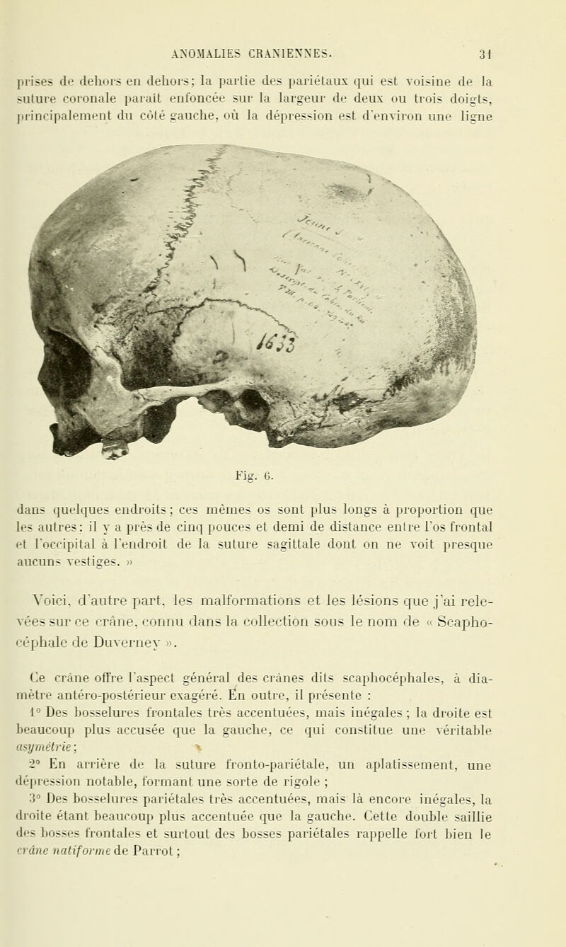 prises de deliors en delioi-s; la paiiie des pariétaux qui est voisine de la suture coronale parait enfoncée sur la largeur de deux ou tiois doigts, jirincipalement du côté gauche, où la dépression est d'environ une ligne Fi?. 0. dans quelques endroits ; ces mêmes os sont plus longs à proportion que les autres; il y a près de cinq pouces et demi de distance enire Fos frontal et Toccipital à Tendroit de la suture sagittale dont on ne voit presque aucuns vestiges. » Voici, crautre part, les malformations et les lésions que jai rele- vées sur ce crâne, connu dans la collection sous le nom de ■ Scapho- céphale de Duverney ■>. Ce crâne offre l'aspect général des crânes dits scaphocéphales, à dia- mètre antéro-postérieur exagéré. En outre, il présente : 1° Des bosselures frontales très accentuées, mais inégales; la droite est beaucoup plus accusée que la gauche, ce qui constitue une véritable asymétrie ; 2° En arrière de la suture fronto-pariétale, un aplatissement, une déjtression notable, formant une sorte de rigole ; V Des bosselures pariétales très accentuées, mais là encore inégales, la droite étant beaucoup plus accentuée que la gauche. Cette double saillie des bosses frontales et surtout des bosses pariétales rappelle fort bien le crâne natifonne de Parrot ;