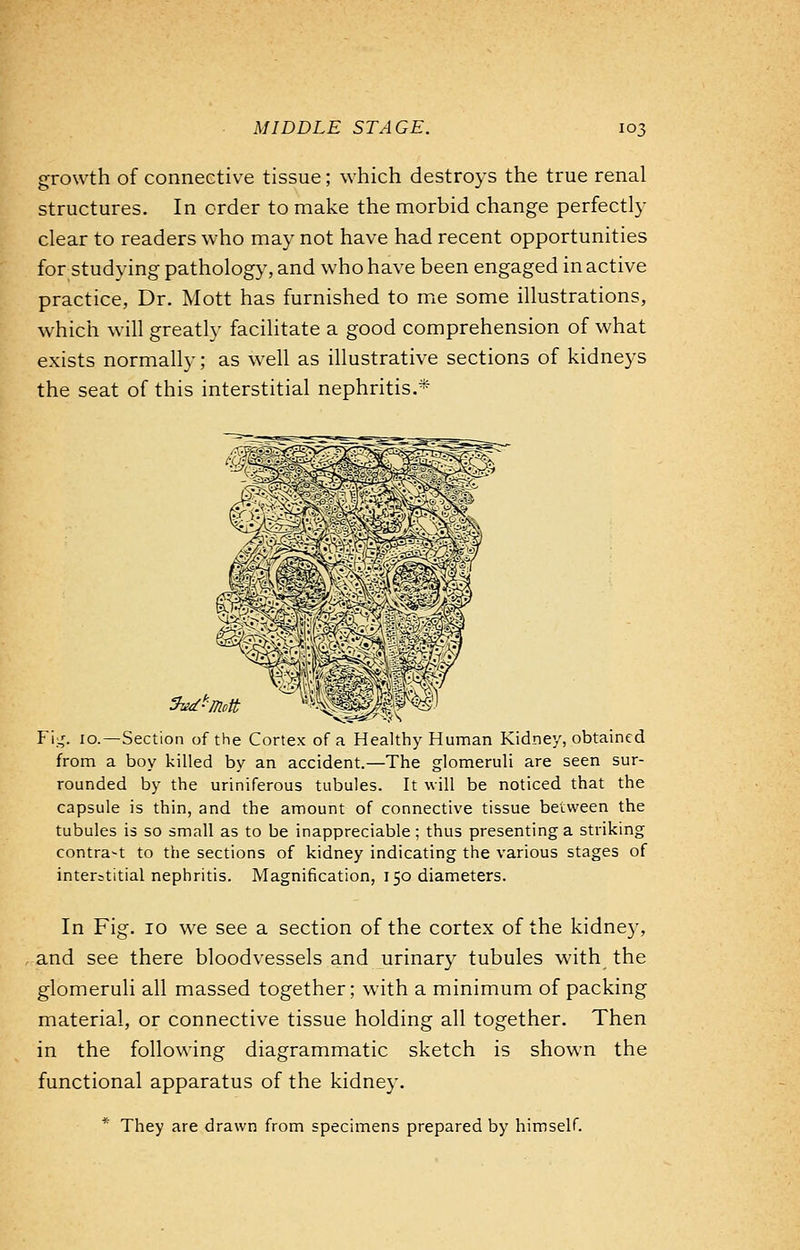 growth of connective tissue; which destroys the true renal structures. In order to make the morbid change perfectly clear to readers who may not have had recent opportunities for studying pathology, and who have been engaged in active practice, Dr. Mott has furnished to me some illustrations, which will greatly facilitate a good comprehension of what exists normally; as well as illustrative sections of kidneys the seat of this interstitial nephritis.* Fig. 10.—Section of the Cortex of a Healthy Human Kidney, obtained from a boy killed by an accident.—The glomeruli are seen sur- rounded by the uriniferous tubules. It will be noticed that the capsule is thin, and the amount of connective tissue between the tubules is so small as to be inappreciable; thus presenting a striking contra-t to the sections of kidney indicating the various stages of interstitial nephritis. Magnification, 150 diameters. In Fig. 10 we see a section of the cortex of the kidney, and see there bloodvessels and urinary tubules with the glomeruli all massed together; with a minimum of packing material, or connective tissue holding all together. Then in the following diagrammatic sketch is shown the functional apparatus of the kidney. * They are drawn from specimens prepared by himself.