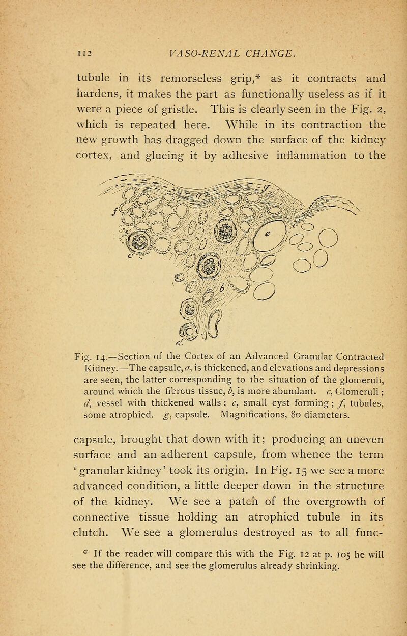 tubule in its remorseless grip,* as it contracts and hardens, it makes the part as functionally useless as if it were a piece of gristle. This is clearly seen in the Fig. 2, which is repeated here. While in its contraction the new growth has dragged down the surface of the kidney cortex, and glueing it by adhesive inflammation to the Fig. 14.—Section of the Cortex of an Advanced Granular Contracted Kidney.—The capsule, a, is thickened, and elevations and depressions are seen, the latter corresponding to the situation of the glomeruli, around which the fibrous tissue, fi, is more abundant, c, Glomeruli; d, vessel with thickened walls ; e, small cyst forming ; f, tubules, some atrophied, g, capsule. Magnifications, 80 diameters. capsule, brought that down with it; producing an uneven surface and an adherent capsule, from whence the term ' granular kidney' took its origin. In Fig. 15 we see a more advanced condition, a little deeper down in the structure of the kidney. We see a patch of the overgrowth of connective tissue holding an atrophied tubule in its clutch. We see a glomerulus destroyed as to all func- 5 If the reader will compare this with the Fig. 12 at p. 105 he will see the difference, and see the glomerulus already shrinking.
