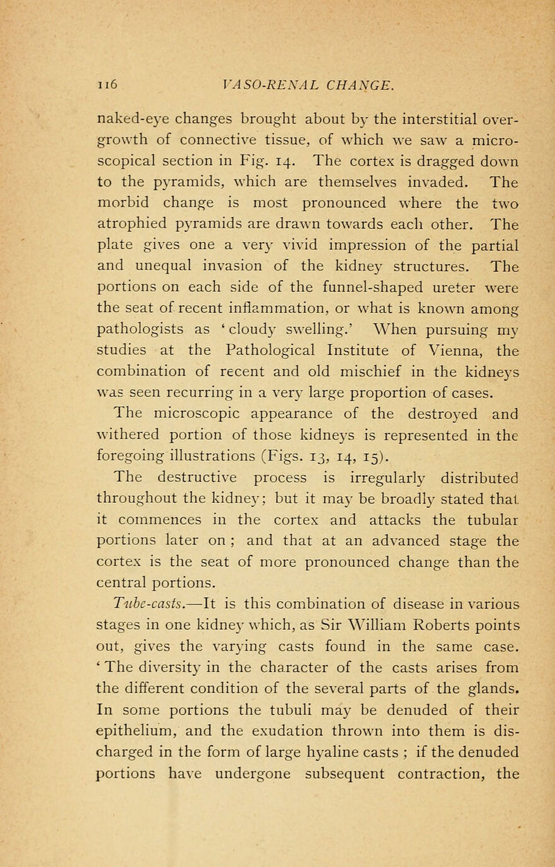 naked-eye changes brought about by the interstitial over- growth of connective tissue, of which we saw a micro- scopical section in Fig. 14. The cortex is dragged down to the pyramids, which are themselves invaded. The morbid change is most pronounced where the two atrophied pyramids are drawn towards each other. The plate gives one a very vivid impression of the partial and unequal invasion of the kidney structures. The portions on each side of the funnel-shaped ureter were the seat of recent inflammation, or what is known among pathologists as ' cloudy swelling.' When pursuing my studies at the Pathological Institute of Vienna, the combination of recent and old mischief in the kidneys was seen recurring in a very large proportion of cases. The microscopic appearance of the destroyed and withered portion of those kidneys is represented in the foregoing illustrations (Figs. 13, 14, 15). The destructive process is irregularly distributed throughout the kidney; but it may be broadly stated that it commences in the cortex and attacks the tubular portions later on ; and that at an advanced stage the cortex is the seat of more pronounced change than the central portions. Tube-casts.—It is this combination of disease in various stages in one kidney which, as Sir William Roberts points out, gives the varying casts found in the same case. ' The diversity in the character of the casts arises from the different condition of the several parts of the glands. In some portions the tubuli may be denuded of their epithelium, and the exudation thrown into them is dis- charged in the form of large hyaline casts ; if the denuded portions have undergone subsequent contraction, the