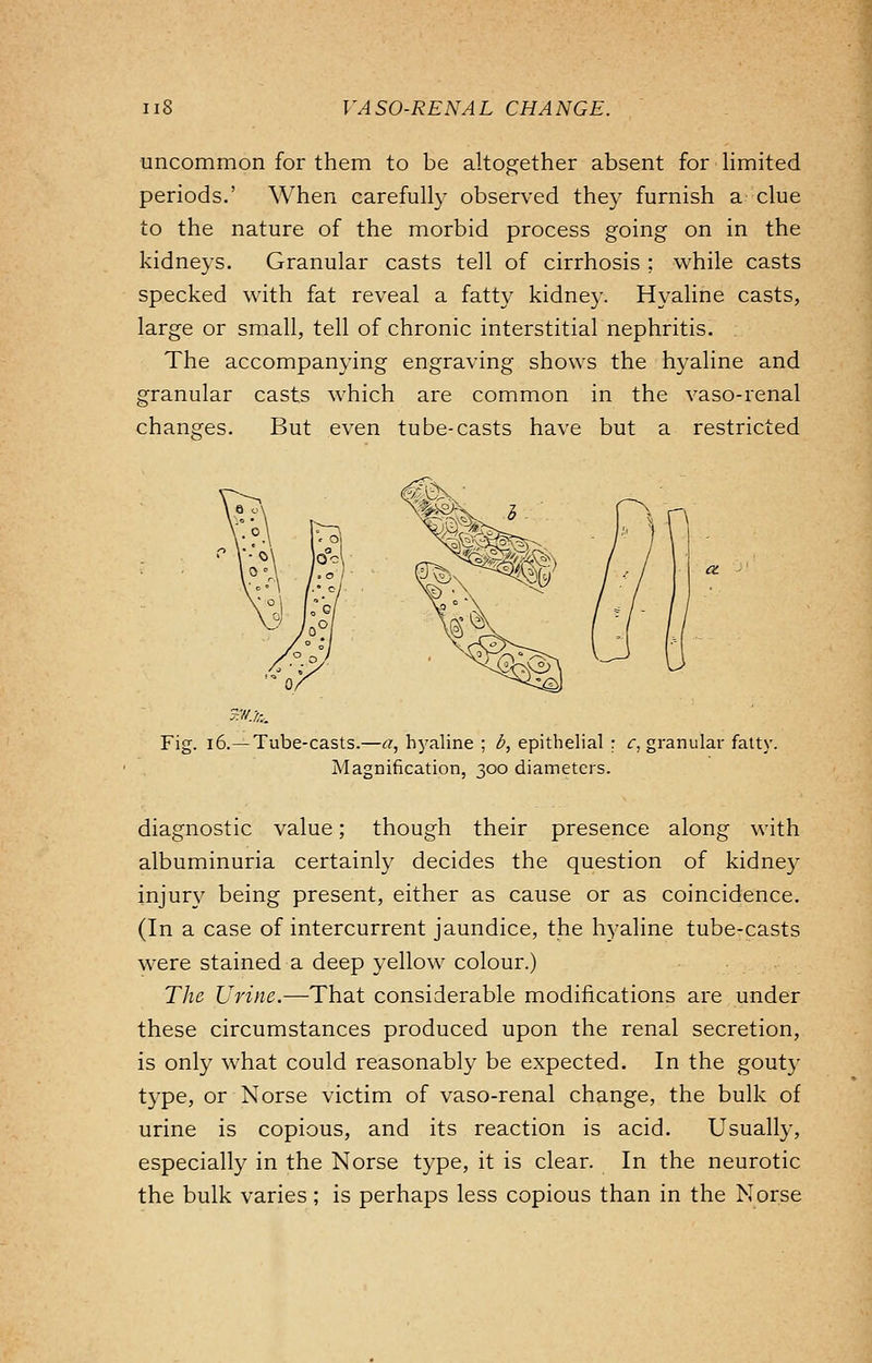 uncommon for them to be altogether absent for limited periods.' When carefully observed they furnish a clue to the nature of the morbid process going on in the kidneys. Granular casts tell of cirrhosis ; while casts specked with fat reveal a fatty kidney. Hyaline casts, large or small, tell of chronic interstitial nephritis. The accompanying engraving shows the hyaline and granular casts which are common in the vaso-renal changes. But even tube-casts have but a restricted z'±. Fig. 16.—Tube-casts.—<?, hyaline ; b, epithelial : c, granular fatty. Magnification, 300 diameters. diagnostic value; though their presence along with albuminuria certainly decides the question of kidney injury being present, either as cause or as coincidence. (In a case of intercurrent jaundice, the hyaline tube-casts were stained a deep yellow colour.) The Urine.—That considerable modifications are under these circumstances produced upon the renal secretion, is only what could reasonably be expected. In the gouty type, or Norse victim of vaso-renal change, the bulk of urine is copious, and its reaction is acid. Usually, especially in the Norse type, it is clear. In the neurotic the bulk varies ; is perhaps less copious than in the Norse