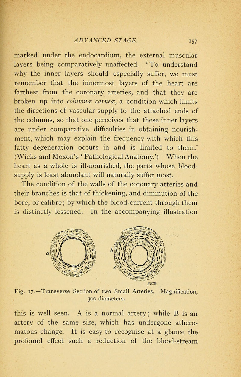 marked under the endocardium, the external muscular layers being comparatively unaffected. ' To understand why the inner layers should especially suffer, we must remember that the innermost layers of the heart are farthest from the coronary arteries, and that they are broken up into columned camece, a condition which limits the directions of vascular supply to the attached ends of the columns, so that one perceives that these inner layers are under comparative difficulties in obtaining nourish- ment, which may explain the frequency with which this fatty degeneration occurs in and is limited to them.' (Wicks and Moxon's ' Pathological Anatomy.') When the heart as a whole is ill-nourished, the parts whose blood- supply is least abundant will naturally suffer most. The condition of the walls of the coronary arteries and their branches is that of thickening, and diminution of the bore, or calibre; by which the blood-current through them is distinctly lessened. In the accompanying illustration Fig. 17.—Transverse Section of two Small Arteries. Magnification, 300 diameters. this is well seen. A is a normal artery; while B is an artery of the same size, which has undergone athero- matous change. It is easy to recognise at a glance the profound effect such a reduction of the blood-stream