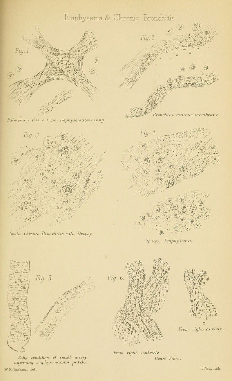 Emphysema & Chrome Bronchitis X V-^: or big-.!. -■_ -■ ■• RiLmoruiry tissue from, emphysematous lung. %2. ^ !*>^r. .-v.- «&-^ .Q'sJ^ssS^'' BronrliLaL rrvurcus' m&rrvbr Fw: 4. i.:-%$[,/' ?■.#;•;' /*;-/ Sputa Chronic Broruiutis witfi, Dropsy. •'■%:■) '*:Hj -; i£2»r Sputcu j Emutvysema-. >*^ ; °-ir- j Fatty conditi/jTU of small art&ry axLjcirilnq emphysematous poachy. WP. Baskam. del. Ftg< Front right auricle.-. From, rigid:* vexibrucLe/. Heart Filtrr. T/Way.lith..