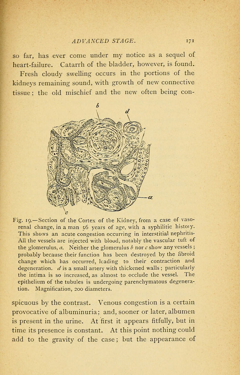 so far, has ever come under my notice as a sequel of heart-failure. Catarrh of the bladder, however, is found. Fresh cloudy swelling occurs in the portions of the kidneys remaining sound, with growth of new connective tissue ; the old mischief and the new often being con- Fig. 19.—Section of the Cortex of the Kidney, from a case of vaso- renal change, in a man 56 years of age, with a syphilitic history. This shows an acute congestion occurring in interstitial nephritis- All the vessels are injected with blood, notably the vascular tuft of the glomerulus, a. Neither the glomerulus b nor c show any vessels ; probably because their function has been destroyed by the fibroid change which has occurred, leading to their contraction and degeneration, d is a small artery with thickened walls ; particularly the intima is so increased, as almost to occlude the vessel. The epithelium of the tubules is undergoing parenchymatous degenera- tion. Magnification, 200 diameters. spicuous by the contrast. Venous congestion is a certain provocative of albuminuria; and, sooner or later, albumen is present in the urine. At first it appears fitfully, but in time its presence is constant. At this point nothing could add to the gravity of the case; but the appearance of