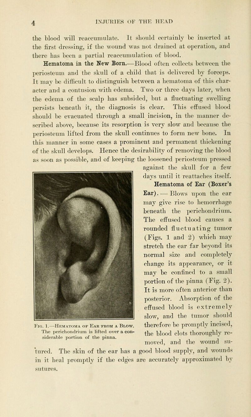 the blood will reaccumulate. It should certainly be inserted at the first dressing, if the wound was not drained at operation, and there has been a partial reaccumulation of blood. Hematoma in the New Born.—Blood often collects between the periosteum and the skull of a child that is delivered by forceps. It may be difficult to distinguish between a hematoma of this char- acter and a contusion with edema. Two or three days later, when the edema of the scalp has subsided, but a fluctuating swelling persists beneath it, the diagnosis is clear. This effused blood should be evacuated through a small incision, in the manner de- scribed above, because its resorption is very slow and because the periosteum lifted from the skull continues to form new bone. In this manner in some cases a prominent and permanent thickening of the skull develops. Hence the desirability of removing the blood as soon as possible, and of keeping the loosened periosteum pressed against the skull for a few days until it reattaches itself. Hematoma of Ear (Boxer's Ear). — Blows upon the ear may give rise to hemorrhage beneath the perichondrium. The effused blood causes a rounded fluctuating tumor (Figs. 1 and 2) which may stretch the ear far beyond its normal size and completely change its appearance, or it may be confined to a small portion of the pinna (Fig. 2). It is more often anterior than posterior. Absorption of the effused blood is extremely slow, and the tumor should therefore be promptly incised, the blood clots thoroughly re- moved, and the wound su- tured. The skin of the ear has a good blood supply, and wounds in it heal promptly if the edges are accurately approximated by sutures. Fig. 1.—Hematoma of Ear from a Blow. The perichondrium is lifted over a con- siderable portion of the pinna.