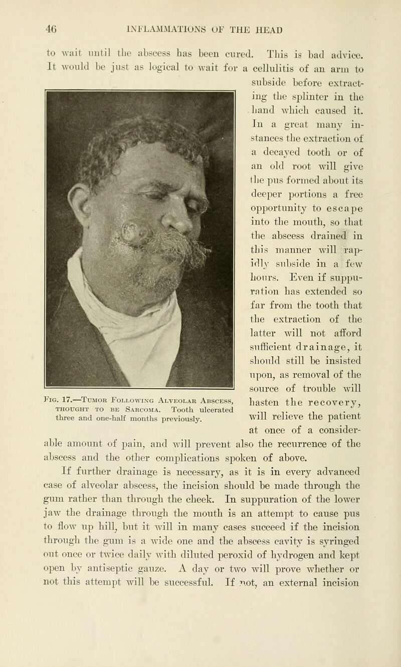 to wait until the abscess lias been cured. This is bad advice. It would be just as logical to wait for a cellulitis of an arm to subside before extract- ing the splinter in the hand which caused it. In a great many in- stances the extraction of a decayed tooth or of an old root will give the ]>ns formed about its deeper portions a free opportunity to escape into the month, so that the abscess drained in this manner will rap- idly subside in a few hours. Even if suppu- ration has extended so far from the tooth that the extraction of the latter will not afford sufficient drainage, it should still be insisted upon, as removal of the source of trouble will hasten the recovery, will relieve the patient at once of a consider- able amount of pain, and will prevent also the recurrence of the abscess and the other complications spoken of above. If further drainage is necessary, as it is in every advanced case of alveolar abscess, the incision should be made through the gum rather than through the cheek. In suppuration of the lower jaw the drainage through the mouth is an attempt to cause pus to flow up hill, but it will in many cases succeed if the incision through the gum is a wide one and the abscess cavity is syringed out once or twice daily with diluted peroxid of hydrogen and kept open by antiseptic gauze. A day or two will prove Avhether or not this attempt will be successful. If not, an external incision Fig. 17.—Tumor Following Alveolar Abscess, thought to be Sarcoma. Tooth ulcerated three and one-half months previously.