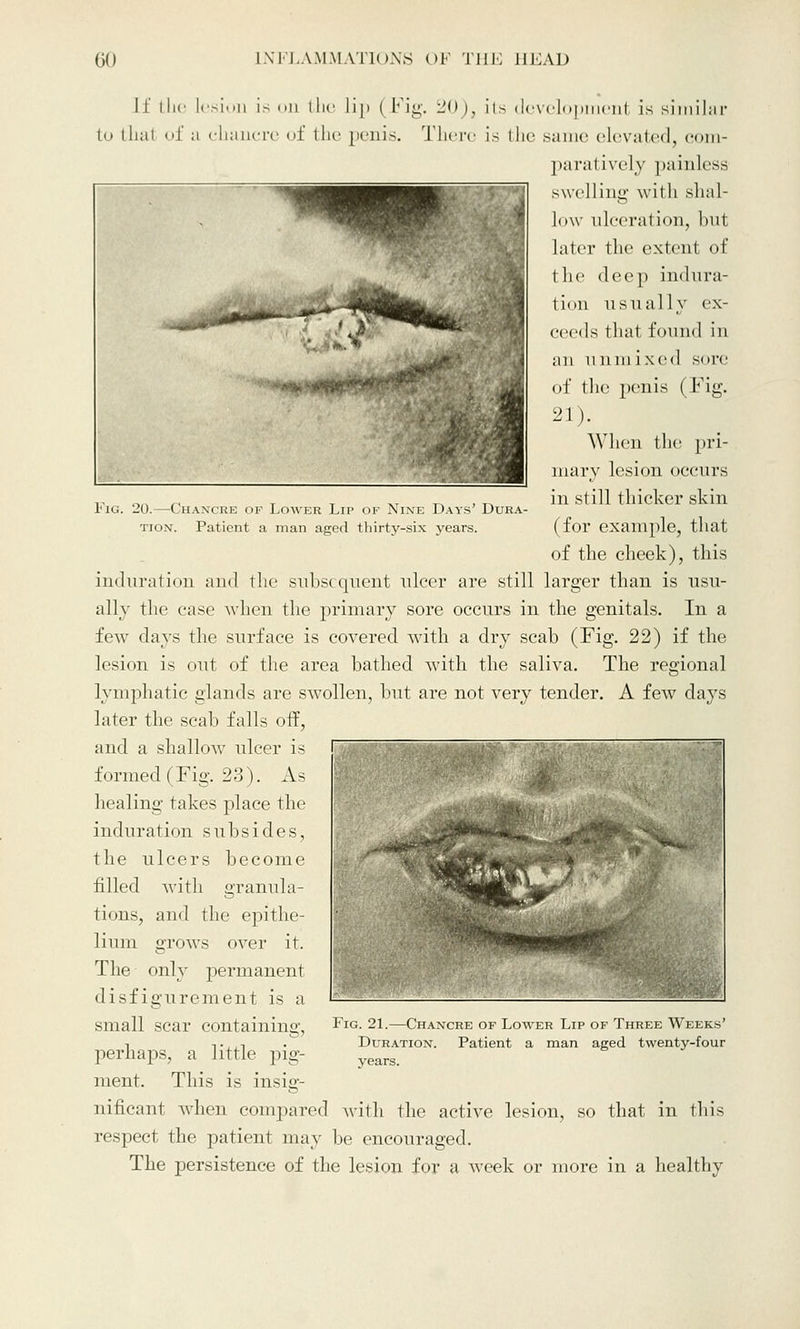 Fig. 20.—Chancre of Lower Lip of Nine Days' Dura- tion. Patient a man aged thirty-six years. Lf the lesion is on the lip (Fig. 20), its dcvelopinenl is similar to thai of a chancre of the penis. There is the same elevated, com- paratively painless swelling with shal- low ulceration, but later the extenl of the deep indura- tion usually ex- ceeds thai found in an unmixed sore of the penis (Fig. 21). When the pri- mary lesion occurs in still thicker skin (for example, that of the cheek), this induration and the subsequent ulcer are still larger than is usu- ally the ease when the primary sore occurs in the genitals. In a few days the surface is covered with a dry scab (Fig. 22) if the lesion is out of the area bathed with the saliva. The regional lymphatic glands are swollen, but are not very tender. A few days later the scab falls off, and a shallow ulcer is formed (Fig. 23). As healing takes place the induration subsides, the ulcers become filled with granula- tions, and the epithe- lium grows over it. The only permanent disfigurement is a small scar containing, perhaps, a little pig- ment. This is insig- nificant when compared with the active lesion, so that in this respect the patient may be encouraged. The persistence of the lesion for a week or more in a healthy Fig. 21.—Chancre of Lower Lip of Three Weeks' Duration. Patient a man aged twenty-four years.