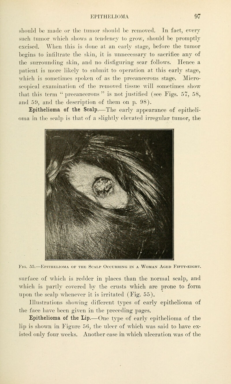 should be made or the tumor should be removed. In fact, every such tumor which shows a tendency to grow, should be promptly excised. When this is done at an early stage, before the tumor begins to infiltrate the skin, it is unnecessary to sacrifice any of the surrounding skin, and no disfiguring scar follows. Hence a patient is more likely to submit to operation at this early stage, which is sometimes spoken of as the precancerous stage. Micro- scopical examination of the removed tissue will sometimes show that this term  precancerous  is not justified (see Figs. 57, 58, and 59, and the description of them on p. 98). Epithelioma of the Scalp.—The early appearance of epitheli- oma in the scalp is that of a slightly elevated irregular tumor, the Fig. 55.—Epithelioma of the Scalp Occurring in a Woman Aged Fifty-eight. surface of which is redder in places than the normal scalp, and which is partly covered by the crusts which are prone to form upon the scalp whenever it is irritated (Fig. 55). Illustrations showing different types of early epithelioma of the face have been given in the preceding pages. Epithelioma of the Lip.—One type of early epithelioma of the lip is shown in Figure 56; the ulcer of which was said to have ex- isted only four weeks. Another case in which ulceration was of the