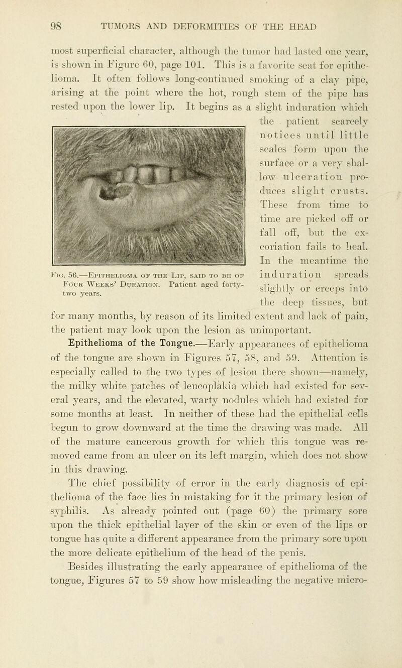 . Fig. .56.—Epithelioma of the Lip, said to be of Four Weeks' Duration. Patient aged forty- two years. most superficial character, although the tumor had Lasted one year, is shown in Figure 60, page 101. This is a favorite scat for epithe- lioma. It often follows long-continued smoking of a clay pipe, arising at the point where the hot, rough stem of the pipe has rested upon the lower lip. It begins as a slight induration which the patient scarcely notices until little scales form upon the surface or a very shal- low Ulcera1 ion pro- duces slight crusts. These from lime to time are picked off or fall off, but the ex- coriation fails to heal. In the meantime the induration spreads slightly or creeps into the deep tissues, but for many months, by reason of its limited extent and lack of pain, the patient may look upon the lesion as unimportant. Epithelioma of the Tongue.—Early appearances of epithelioma of the tongue are shown in Figures 57, 58, and 59. Attention is especially called to the two types of lesion there shown—namely, the milky white patches of leucoplakia which had existed for sev- eral years, and the elevated, warty nodules which had existed for some months at least. In neither of these had the epithelial cells begun to grow downward at the time the drawing was made. All of the mature cancerous growth for which this tongue was re- moved came from an ulcer on its left margin, which does not show in this drawing. The chief possibility of error in the early diagnosis of epi- thelioma of the face lies in mistaking for it the primary lesion of syphilis. As already pointed out (page 60) the primary sore upon the thick epithelial layer of the skin or even of the lips or tongue has quite a different appearance from the primary sore upon the more delicate epithelium of the head of the penis. Besides illustrating the early appearance of epithelioma of the tongue, Figures 57 to 59 show how misleading the negative micro-