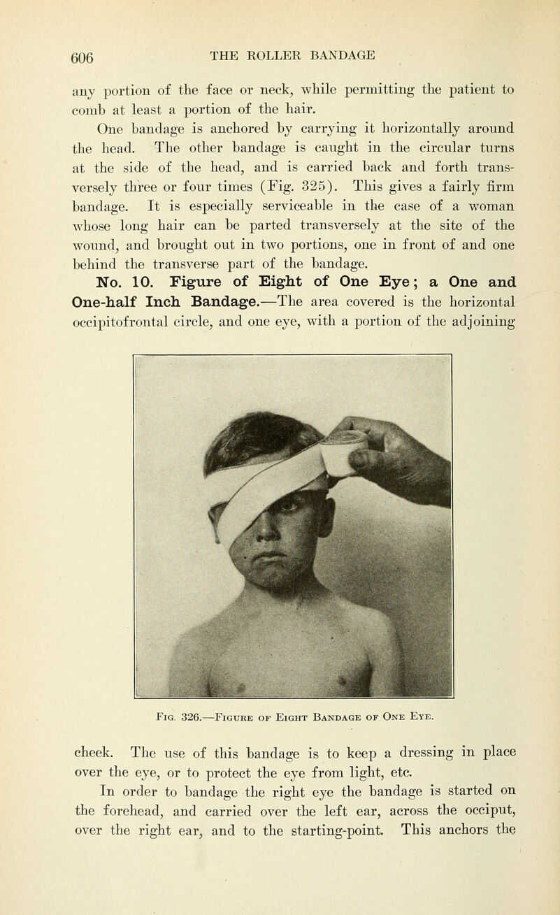 any portion of the face or neck, while permitting the patient to comb at least a portion of the hair. One bandage is anchored by carrying it horizontally around the head. The other bandage is caught in the circular turns at the side of the head, and is carried back and forth trans- versely three or four times (Fig. 325). This gives a fairly firm bandage. It is especially serviceable in the case of a woman whose long hair can be parted transversely at the site of the wound, and brought out in two portions, one in front of and one behind the transverse part of the bandage. No. 10. Figure of Eight of One Eye; a One and One-half Inch Bandage.—The area covered is the horizontal occipitofrontal circle, and one eye, with a portion of the adjoining Fig. 326.—Figure of Eight Bandage of One Eye. cheek. The use of this bandage is to keep a dressing in place over the eye, or to protect the eye from light, etc. In order to bandage the right eye the bandage is started on the forehead, and carried over the left ear, across the occiput, over the right ear, and to the starting-point. This anchors the