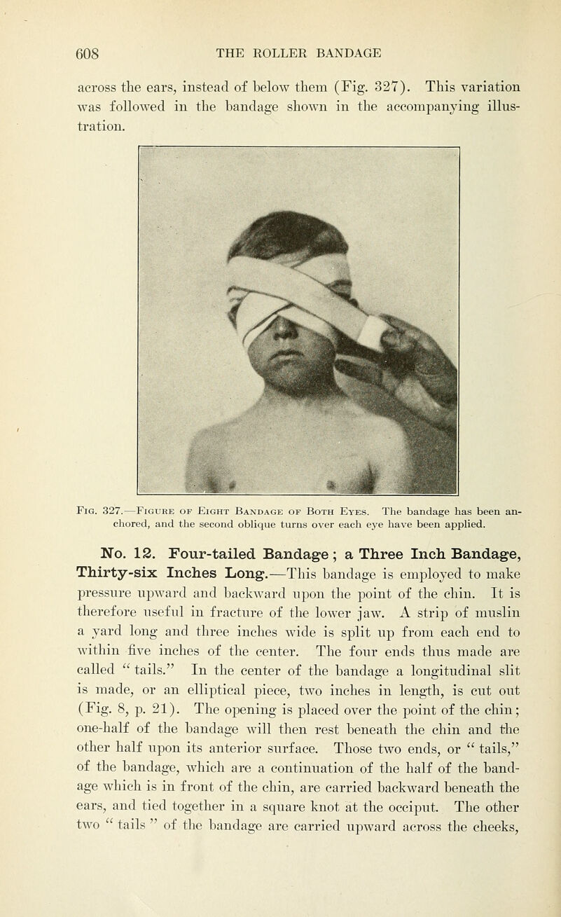 across the ears, instead of below them (Fig. 32Y). This variation was followed in the bandage shown in the accompanying illus- tration. Fig. 327.—Figure of Eight Bandage of Both Eyes. The bandage has been an- chored, and the second oblique turns over each eye have been applied. No. 12. Four-tailed Bandage; a Three Inch Bandage, Thirty-six Inches Long.—This bandage is employed to make pressure upward and backward upon the point of the chin. It is therefore useful in fracture of the lower jaw. A strip of muslin a yard long and three inches wide is split up from each end to within five inches of the center. The four ends thus made are called  tails. In the center of the bandage a longitudinal slit is made, or an elliptical piece, two inches in length, is cut out (Fig. 8, p. 21). The opening is placed over the point of the chin; one-half of the bandage will then rest beneath the chin and the other half upon its anterior surface. Those two ends, or  tails, of the bandage, which are a continuation of the half of the band- age which is in front of the chin, are carried backward beneath the ears, and tied together in a square knot at the occiput. The other two  tails  of the bandage are carried upward across the cheeks,