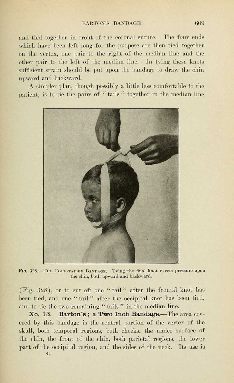 and tied together in front of the coronal suture. The four ends which have been left long for the purpose are then tied together on the vertex, one pair to the right of the median line and the other pair to the left of the median line. In tying these knots sufficient strain should be put upon tlie bandage to draw the chin upward and backward. A simpler plan, though possibly a little less comfortable to the patient, is to tie the pairs of  tails  together in the median line Fig. 328.—The Four-tailed Bandage. Tying the final knot exerts pressure upon the chin, both upward and backward. (Fig. 328), or to cut off one tail after the frontal knot has been tied, and one  tail  after the occipital knot has been tied, and to tie the two remaining  tails  in the median line. No. 13. Barton's ; a Two Inch Bandage.—The area cov- ered by this bandage is the central portion of the vertex of the skull, both temporal regions, both cheeks, the under surface of the chin, the front of the chin, both parietal regions, the lower part of the occipital region, and the sides of the neck. Its use is 41