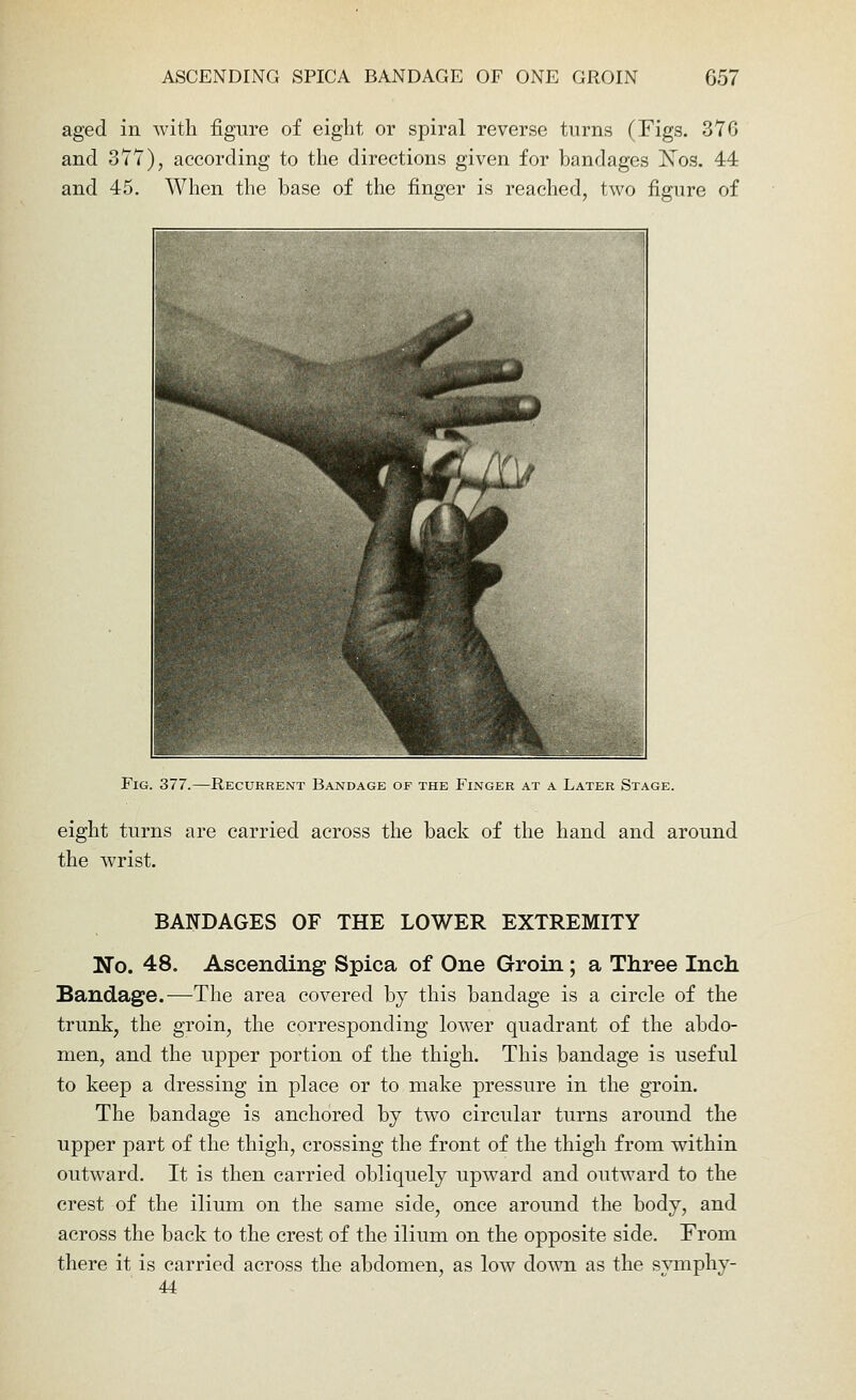 aged in with figure of eight or spiral reverse turns (Figs. 376 and 377), according to the directions given for bandages Xos. 44 and 45. When the base of the finger is reached, two figure of Fig. 377.—Recurrent Bandage of the Finger at a Later Stage. eight turns are carried across the back of the hand and around the wrist. BANDAGES OF THE LOWER EXTREMITY No. 48. Ascending Spica of One Groin ; a Three Inch Bandage.—The area covered by this bandage is a circle of the trunk, the groin, the corresponding lower quadrant of the abdo- men, and the upper portion of the thigh. This bandage is useful to keep a dressing in place or to make pressure in the groin. The bandage is anchored by two circular turns around the upper part of the thigh, crossing the front of the thigh from within outward. It is then carried obliquely upward and outward to the crest of the ilium on the same side, once around the body, and across the back to the crest of the ilium on the opposite side. From there it is carried across the abdomen, as low down as the svmphy- 44