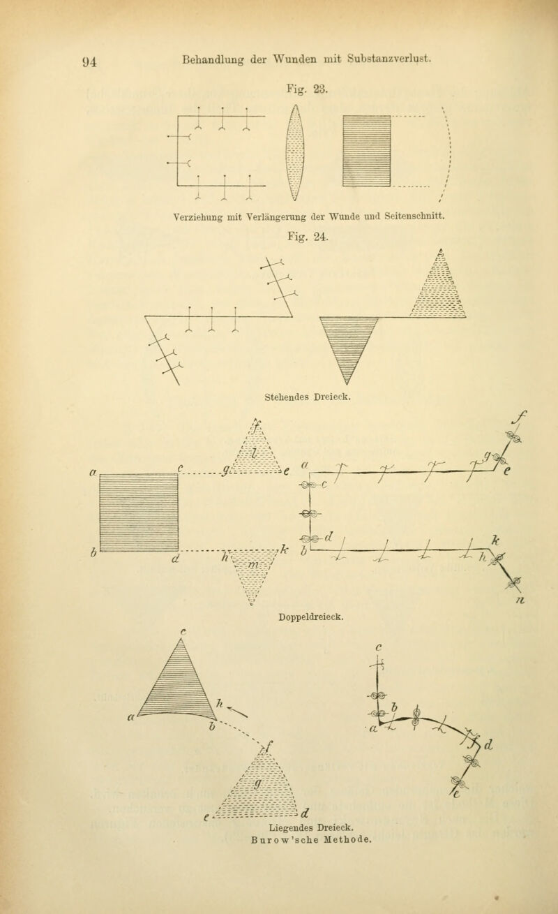 Fic.. 23. Verziehung mit Verlängerung der Wunde und Seitenschnitt. Fisr. 24. ,*. A A Stehendes Dreieck. wv---=v:i<; stl d / / / ^.-.-^y:,k i\ i 1- 4 4- Doppeldreieck. h\ n. '^d ^m Liegendes Dreieck. Burow'sche Methode.