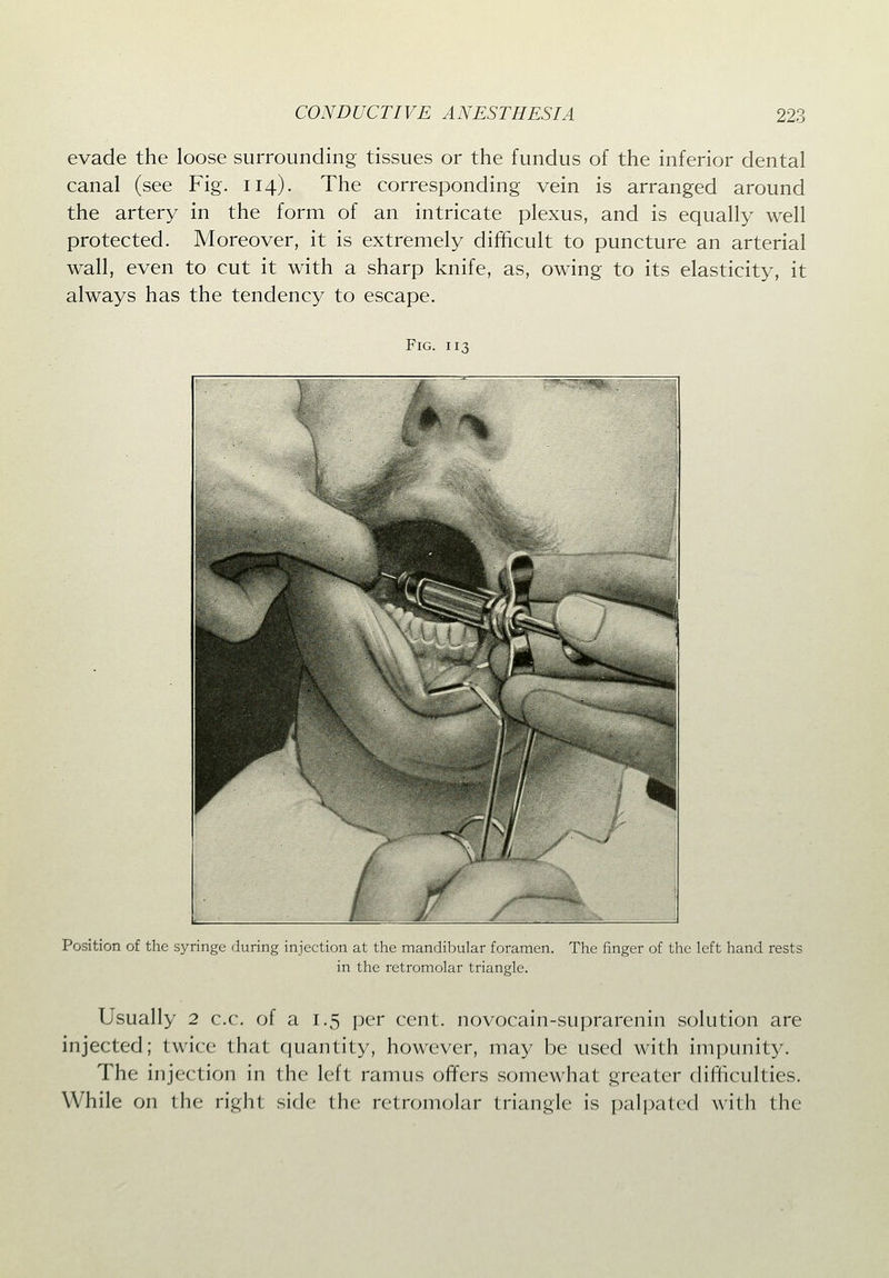 evade the loose surrounding tissues or the fundus of the inferior dental canal (see Fig. 114). The corresponding vein is arranged around the artery in the form of an intricate plexus, and is equally well protected. Moreover, it is extremely difficult to puncture an arterial wall, even to cut it with a sharp knife, as, owing to its elasticity, it always has the tendency to escape. Fig. 113 Position of the syringe during injection at the mandiliular foramen. The finger of the left hand rests in the retromolar triangle. Usually 2 c.c. of a 1.5 per cent, novocain-suprarenin solution are injected; twice that quantity, however, may be used with impunity. The injection in the left ramus offers somewhat greater difficulties. While on the right side the retromolar triangle is palpated with the