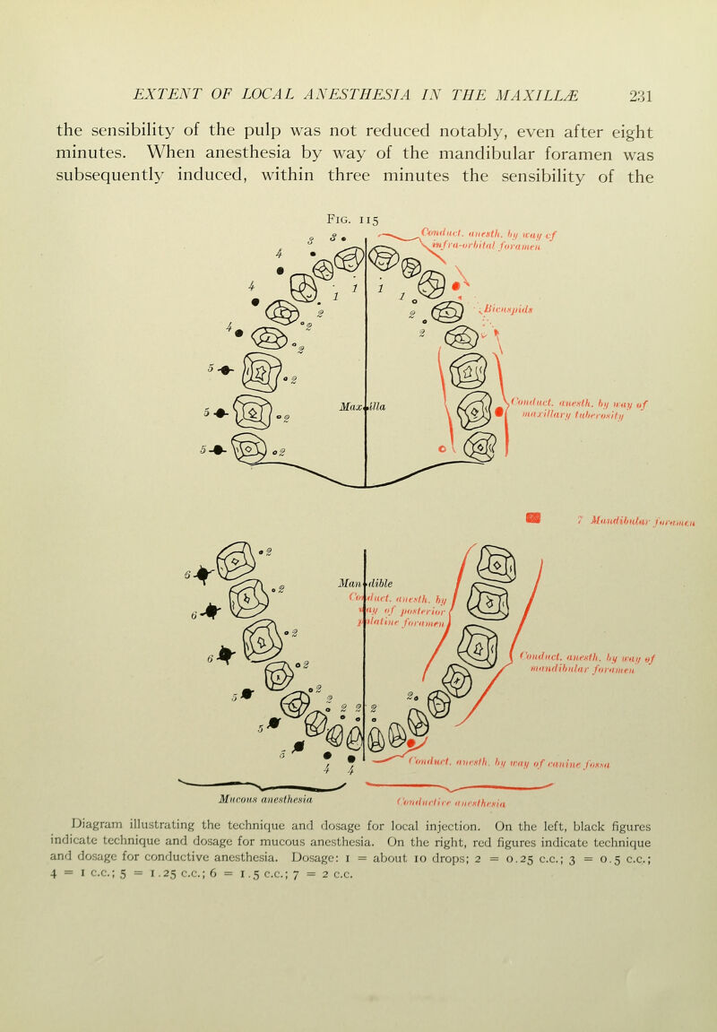 the sensibility of the pulp was not reduced notably, even after eight minutes. When anesthesia by way of the mandibular foramen was subsequently induced, within three minutes the sensibility of the Fig. 115 Couducl. (inesth. hy way vf ^\mfra-orhital foramen ... ('itduct. aw-fsth. hi/ way 0/ ^ll*i iniirlllari/ fuhi'iosif,,' 7 ManriUmiar funimen Conduct, (me-stli. hy way of mandihidar foraiUfu MitcouH anexthema (oiidnct. >nii:sfh. hy way of muluti fnssa Conduct ire an eMhenia Diagram illustrating the technique and dosage for local injection. On the left, black figures indicate technique and dosage for mucous anesthesia. On the right, red figures indicate technique and dosage for conductive anesthesia. Dosage: i = about 10 drops; 2 = 0.25 c.c; 3 = 0.5 c.c; 4 = I c.c; 5 = 1.25 c.c; 6 = 1.5 c-c-i 7 = 2 c.c.