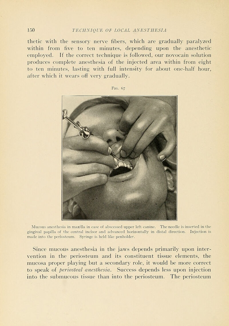 thetic with the sensory nerve fibers, which are gradually paralyzed within from five to ten minutes, depending upon the anesthetic employed. If the correct technique is followed, our novocain solution produces complete anesthesia of the injected area within from eight to ten minutes, lasting with full intensity for about one-half hour, after which it wears off very gradually. Fig. 67 Mucous anesthesia in maxilla in case of abscessed upper left canine. The needle is inserted in the gingival papilla of the central incisor and advanced horizontally in distal direction. Injection is made into the periosteum. Syringe is held like penholder. Since mucous anesthesia in the jaws depends primarily upon inter- vention in the periosteum and its constituent tissue elements, the mucosa proper playing but a secondary role, it would be more correct to speak of periosteal anesthesia. Success depends less upon injection into the submucous tissue than into the periosteum. The periosteum