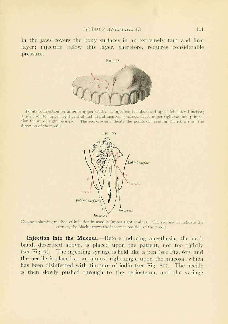 in the jaws covers the bony surfaces in an extremely taut and firm layer; injection below this layer, therefore, requires considerable pressure. Fig. 68 Points of injection for anterior upper teeth: i, injection for abscessed upper left lateral incisor; 2, injection for upper right central and lateral incisors; 3, injection for upper right canine; 4, injec- tion for upper right bicuspid. The red crosses indicate the points of injection,'the red arrows the direction of the needle. Fig. Diagram showing method of injection in maxilla (upper right canine). The red arrows indicate the correct, the black arrows the incorrect position of the needle. Injection into the Mucosa.—Before inducing anesthesia, the neck band, described above, is placed upon the patient, not too tighth- (see Fig. 5). The injecting syringe is held like a pen (see Fig. 67), and the needle is placed at an almost right angle upon the mucosa, which has been disinfected with tincture of iodin (see Fig. 81). The needle is then slowly pushed through to the periosteum, and the syringe