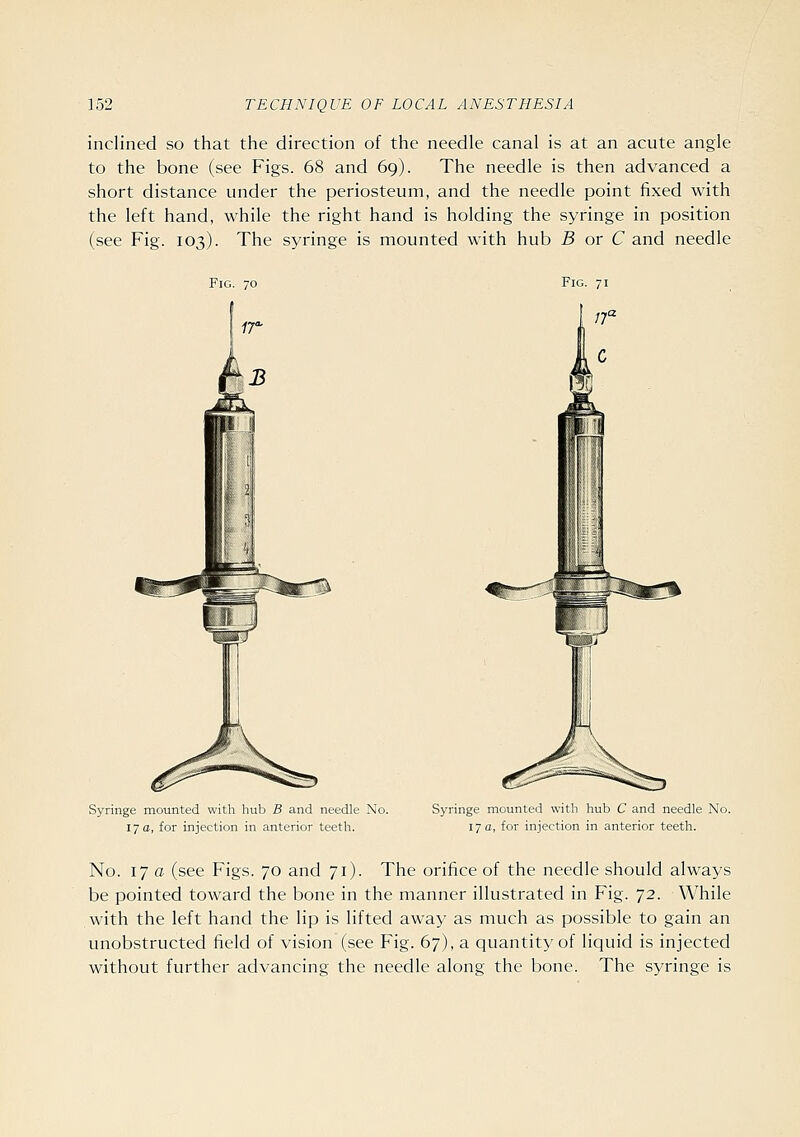 inclined so that the direction of the needle canal is at an acute angle to the bone (see Figs. 68 and 69). The needle is then advanced a short distance under the periosteum, and the needle point fixed with the left hand, while the right hand is holding the syringe in position (see Fig. 103). The syringe is mounted with hub B or C and needle Syringe mounted with hub B and needle No. 17 a, for injection in anterior teeth. Syringe mounted with hub C and needle No. 17 a, for injection in anterior teeth. No. 17 a (see Figs. 70 and 71). The orifice of the needle should always be pointed toward the bone in the manner illustrated in Fig. '/2. While with the left hand the lip is lifted away as much as possible to gain an unobstructed field of vision (see Fig. 67), a quantity of liquid is injected without further advancing the needle along the bone. The syringe is