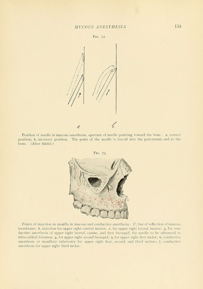 Fig. 72 4 ^ Position of needle in mucous anesthesia, aperture of needle pointing toward the bone: a, correct position; b, incorrect position. The point of the needle is forced into the periosteum and to the bone. (After Seidel.) Fig. 73 Points of injection in maxilla in mucous and conductive anesthesia: U, line of reflection of mucous membrane; I, injection for upper right central incisor; 2, for upper right lateral incisor; 3, for con- ductive anesthesia of upper right lateral, canine, and first bicuspid, the needle to be advanced to infra-orbital foramen; 4, for upper right second bicuspid; 5, for upper right first molar; 6, conductive anesthesia at maxillary tuberosity for upper right first, second, and third molars; 7, conductive anesthesia for upper right tliird molar.