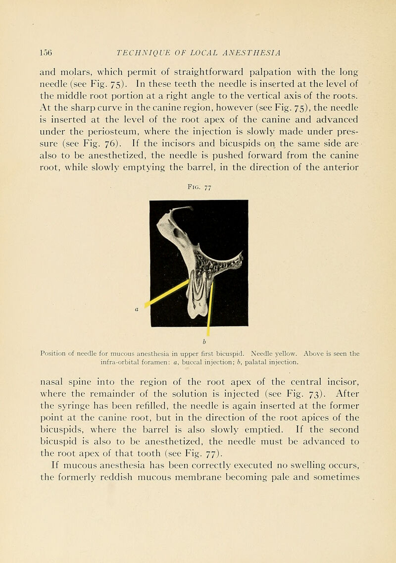 and molars, which permit of straightforward palpation with the long needle (see Fig. 75). In these teeth the needle is inserted at the level of the middle root portion at a right angle to the vertical axis of the roots. At the sharp curve in the canine region, however (see Fig. 75), the needle is inserted at the level of the root apex of the canine and advanced under the periosteum, where the injection is slowly made under pres- sure (see Fig. 76). If the incisors and bicuspids on the same side are • also to be anesthetized, the needle is pushed forward from the canine root, while slowly emptying the barrel, in the direction of the anterior Fig. 77 Position of needle for mucous anesthesia in upper first bicuspid. Needle yellow. Above is seen the infra-orbital foramen: a, buccal injection; b, palatal injection. nasal spine into the region of the root apex of the central incisor, where the remainder of the solution is injected (see Fig. 73). After the syringe has been refilled, the needle is again inserted at the former point at the canine root, but in the direction of the root apices of the bicuspids, where the barrel is also slowly emptied. If the second bicuspid is also to be anesthetized, the needle must be advanced to the root apex of that tooth (see Fig. 77). If mucous anesthesia has been correctly executed no swelling occurs, the formerly reddish mucous membrane becoming pale and sometimes
