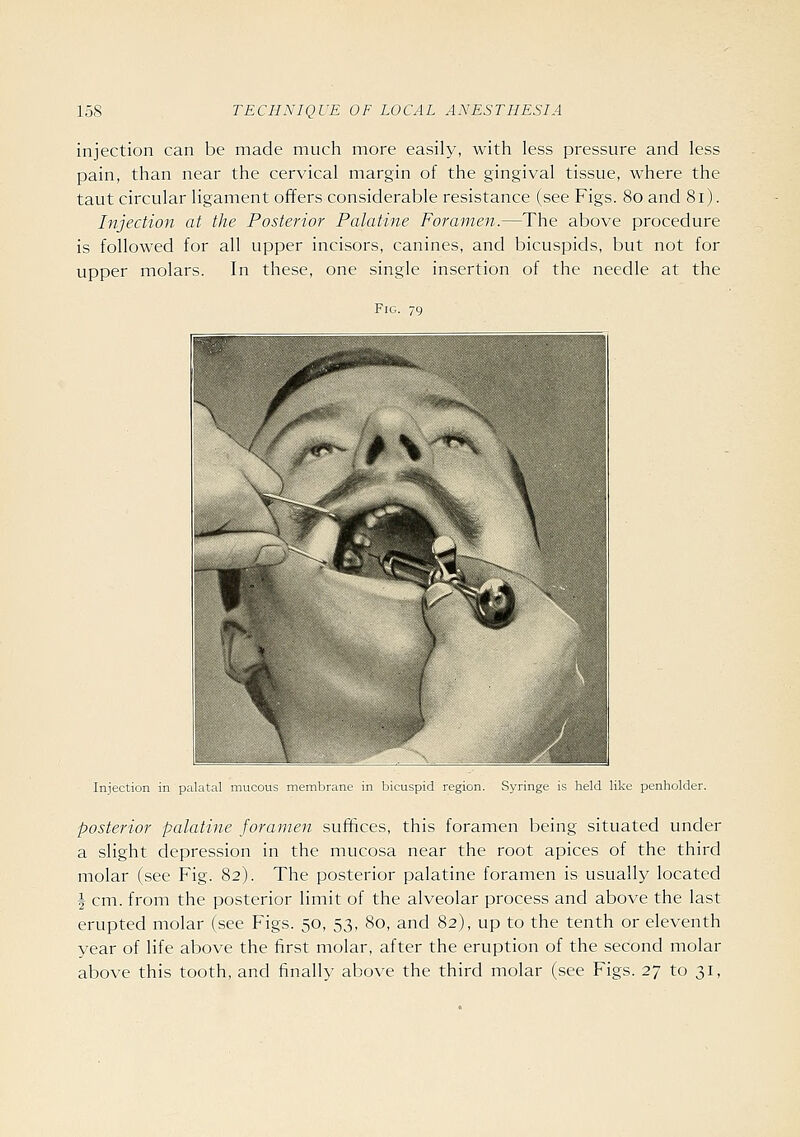injection can be made much more easily, with less pressure and less pain, than near the cervical margin of the gingival tissue, where the taut circular ligament offers considerable resistance (see Figs. 80 and 81). Injection at the Posterior Palatine Foramen.—The above procedure is followed for all upper incisors, canines, and bicuspids, but not for upper molars. In these, one single insertion of the needle at the Fig. 79 Injection in palatal mucous membrane in bicuspid region. Syringe is held like penholder. posterior palatine foramen suffices, this foramen being situated under a slight depression in the mucosa near the root apices of the third molar (see Fig. 82). The posterior palatine foramen is usually located ^ cm. from the posterior limit of the alveolar process and above the last erupted molar (see Figs. 50, 53, 80, and 82), up to the tenth or eleventh year of life above the first molar, after the eruption of the second molar above this tooth, and finally above the third molar (see Figs. 2-j to 31,