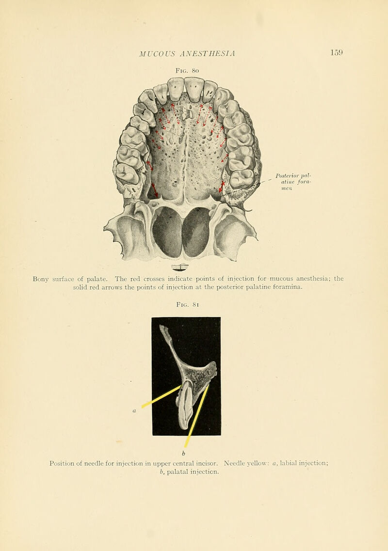 Fig. So Posterior pal- atine fora- Bony surface of palate. The red crosses indicate points of injection for mucous anesthesia; the soUd red arrows the points of injection at the posterior palatine foramina. Position of needle for injection in upper central incisor. Needle yellow: a, labial injection; b, palatal injection.