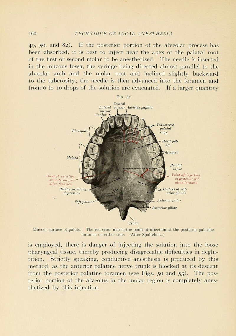 49, 50, and 82). If the posterior portion of the alveolar process has been absorbed, it is best to inject near the apex of the palatal root of the first or second molar to be anesthetized. The needle is inserted in the mucous fossa, the syringe being directed almost parallel to the alveolar arch and the molar root and inclined slightly backward to the tuberosity; the needle is then advanced into the foramen and from 6 to 10 drops of the solution are evacuated. If a larger quantity Fig. 82 Central Lateral incisor Incisive papilla incisor Canine Transverse palatal rugx Point of injection at posterior2ml- ' aline foramen Palato-maxillary , depression Soft palate^' ,^^ Point of injection (it posterior pal- atine foramen Z.-^ Orifices of pal- atine glands Anterior pillar ior pillar Mucous surface of palate. The red cross marks the point of injection at the posterior palatine foramen on either side. (After Spalteholz.) is employed, there is danger of injecting the solution into the loose pharyngeal tissue, thereby producing disagreeable difficulties in deglu- tition. Strictly speaking, conductive anesthesia is produced by this method, as the anterior palatine nerve trunk is blocked at its descent from the posterior palatine foramen (see Figs. 50 and 53). The pos- terior portion of the alveolus in the molar region is completely anes- thetized by this injection.
