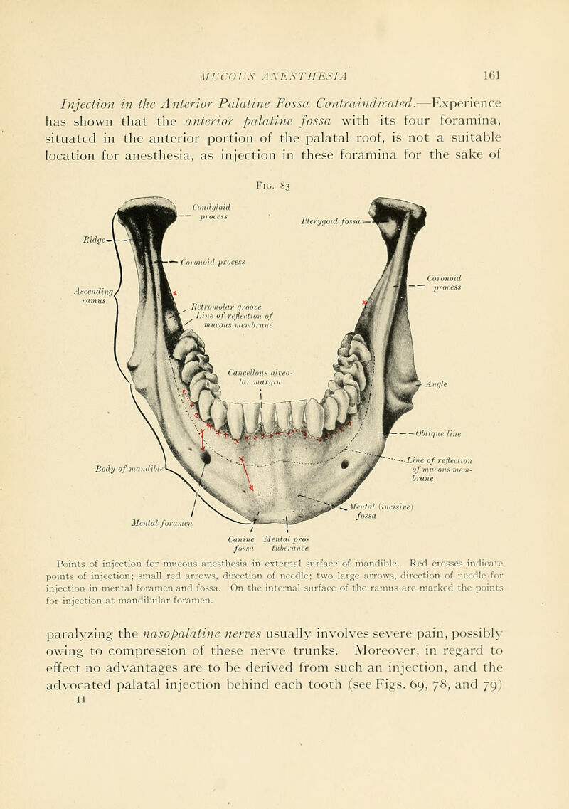 MUCOUS ANESTHESIA Kil Injection in tlic Anterior Palatine Fossa Contraindicated.—Experience has shown that the anterior palatine fossa with its four foramina, situated in the anterior portion of the palatal roof, is not a suitable location for anesthesia, as injection in these foramina for the sake of Fig. 83 Mi'iital fora ilenitil {incisive) fossa Cniiive Mental pro- fossa tiibeiunce Points of injection for mucous anesthesia in external surface of mandible. Red crosses indicate points of injection; small red arrows, direction of needle; two large arrows, direction of needle for injection in mental foramen and fossa. On the internal surface of the ramus are marked the points for injection at mandibular foramen. paralyzing the nasopalatine nerves usually involves severe pain, possibly owing to compression of these nerve trunks. Moreover, in regard to effect no advantages are to be derived from such an injection, and the advocated palatal injection behind each tooth (see Figs. 69, 78, and 79) 11
