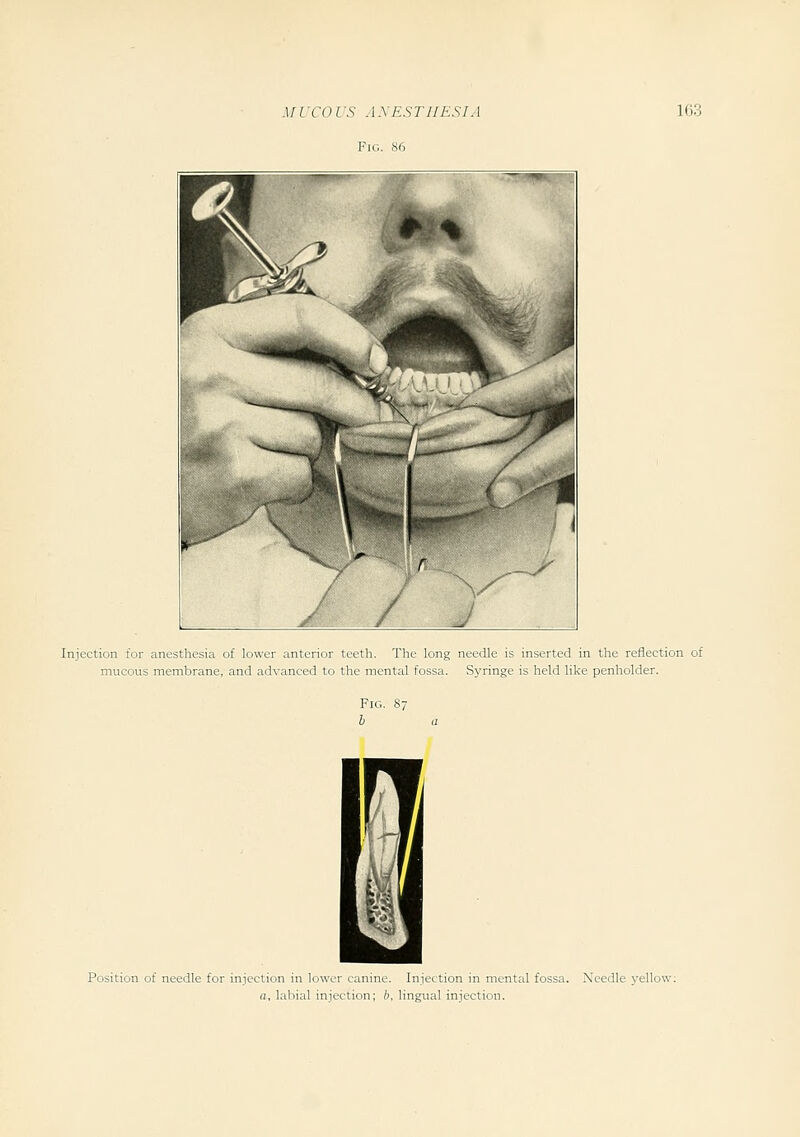 Fig. S6 Injection for anesthesia of lower anterior teeth. The long mucous membrane, and advanced to the mental fossa. Fig. h needle is inserted in the reflection of Syringe is held like penholder. Position of needle for injection in lower canine. Injection in mental fossa. Needle yellow: a, labial injection; b, lingual injection.