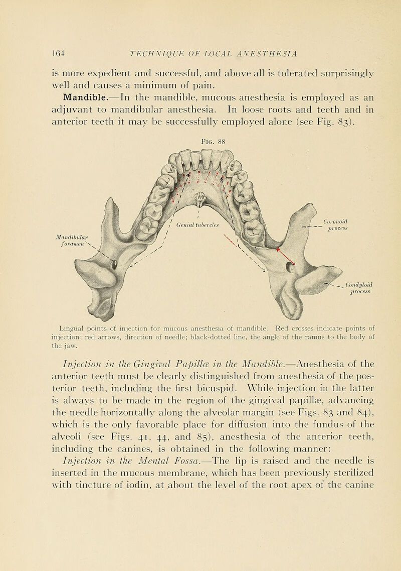 is more expedient and successful, and above all is tolerated surprisingly well and causes a minimum of pain. Mandible.—In the mandible, mucous anesthesia is employed as an adjuvant to mandibular anesthesia. In loose roots and teeth and in anterior teeth it may be successfully employed alone (see Fig. 83). Fig. 88 ^'^ -.,_^ Condyloid i^^f process Lingual points of injection for mucous anesthesia of mandible. Red crosses indicate points of injection; red arrows, direction of needle; black-dotted line, the angle of the ramus to the body of the jaw. Injection in the Gingival Papillce in the Mandible.—Anesthesia of the anterior teeth must be clearly distinguished from anesthesia of the pos- terior teeth, including the first bicuspid. While injection in the latter is always to be made in the region of the gingival papillae, advancing the needle horizontally along the alveolar margin (see Figs. 83 and 84), which is the only favorable place for diffusion into the fundus of the alveoli (see Figs. 41, 44, and 85), anesthesia of the anterior teeth, including the canines, is obtained in the following manner: Injectio7i in the Mental Fossa.—The lip is raised and the needle is inserted in the mucous membrane, which has been previously sterilized with tincture of iodin, at about the level of the root apex of the canine