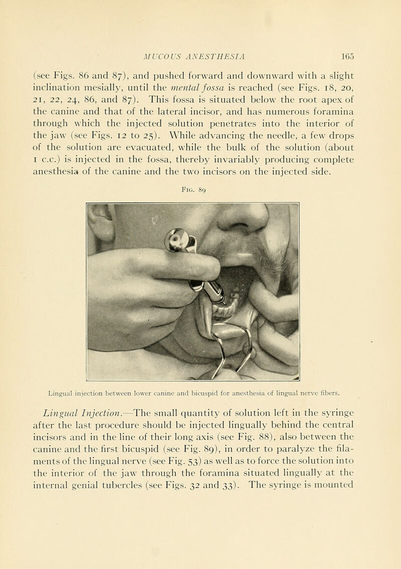 (see Figs. 86 and 87), and pushed forward and downward with a sHght inclination mesially, until the mental fossa is reached (see Figs. 18, 20, 21, 22, 24, 86, and 87). This fossa is situated below the root apex of the canine and that of the lateral incisor, and has numerous foramina through which the injected solution penetrates into the interior of the jaw' (see Figs. 12 to 25). While advancing the needle, a few drops of the solution are evacuated, while the bulk of the solution (about I c.c.) is injected in the fossa, thereby invariably producing complete anesthesia of the canine and the two incisors on the injected side. Fig. 89 Lingual injection between lower canine and bicuspid for anestliesia of lingual nerve fibers. Lingual Injection.—The small quantity of solution left in the syringe after the last procedure should be injected lingually behind the central incisors and in the line of their long axis (see Fig. 88), also between the canine and the first bicuspid (see Fig. 89), in order to paralyze the fila- ments of the lingual nerve (see Fig. 53) as well as to force the solution into the interior of the jaw through the foramina situated lingually at the internal genial tubercles (see Figs. 32 and 33). The syringe is mounted