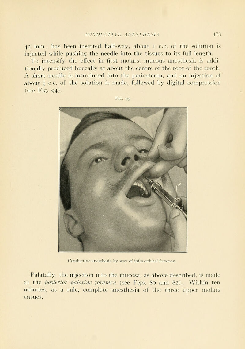 42 mm., has been inserted half-way, al)oul i c.c. of the solution is injected while pushing the needle into the tissues to its full length. To intensify the effect in first molars, mucous anesthesia is addi- tionally produced buccally at about the centre of the root of the tooth. A short needle is introduced into the periosteum, and an injecticjn of about J c.c. of the solution is made, followed by digital compression (see Fig. 94). Fig. 9,5 Conductive anesthesia by way of infra-orbital foramen. Palatally, the injection into the mucosa, as above described, is made at the posterior palatine foramen (see Figs. 80 and 82). Within ten minutes, as a rule, complete anesthesia of the three upper molars ensues.